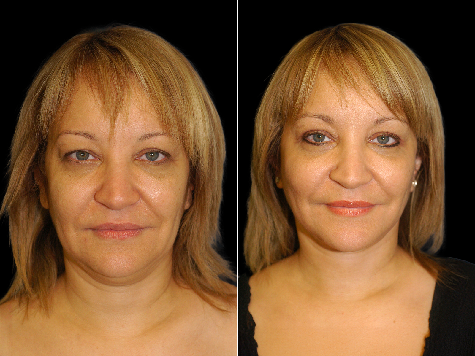 This patient underwent The UpLyft™ facelift combined with a platysmaplasty, fat transfer to the tear trough and nasolabial fold, and quad blepharoplasty.