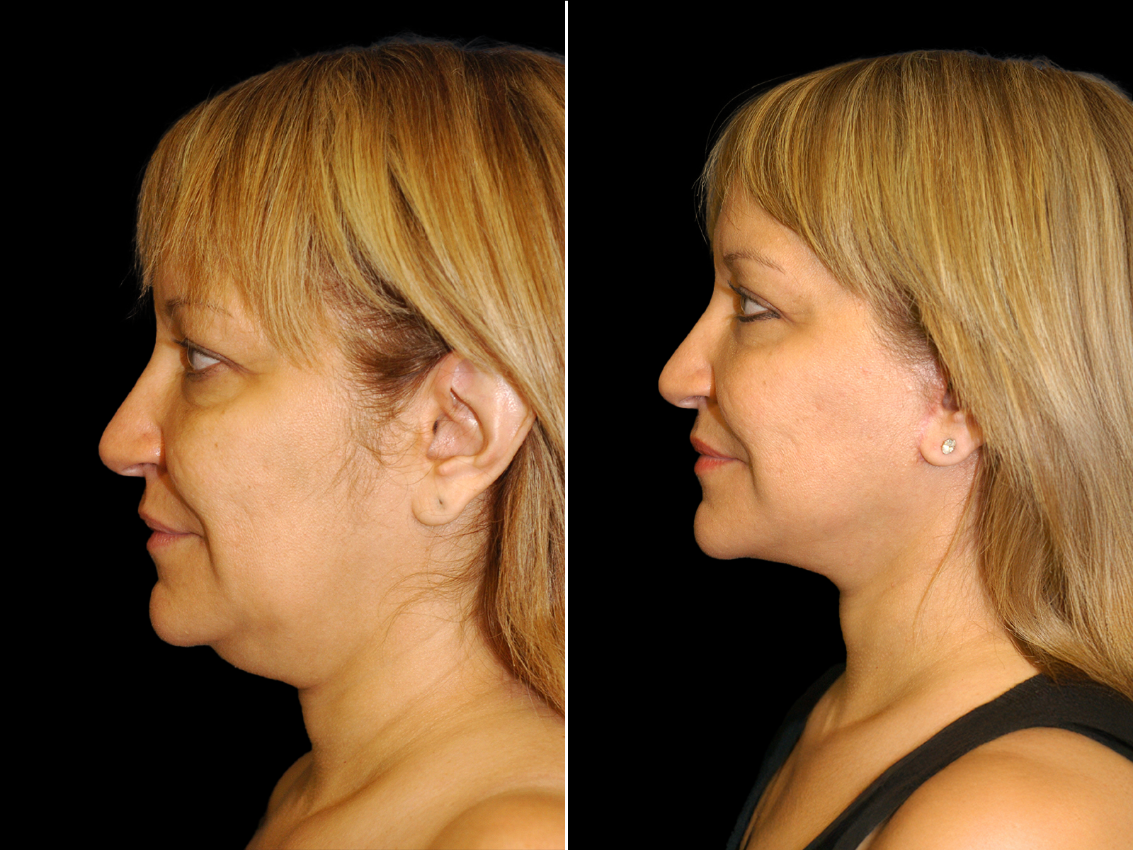 This patient underwent The UpLyft™ facelift combined with a platysmaplasty, fat transfer to the tear trough and nasolabial fold, and quad blepharoplasty.