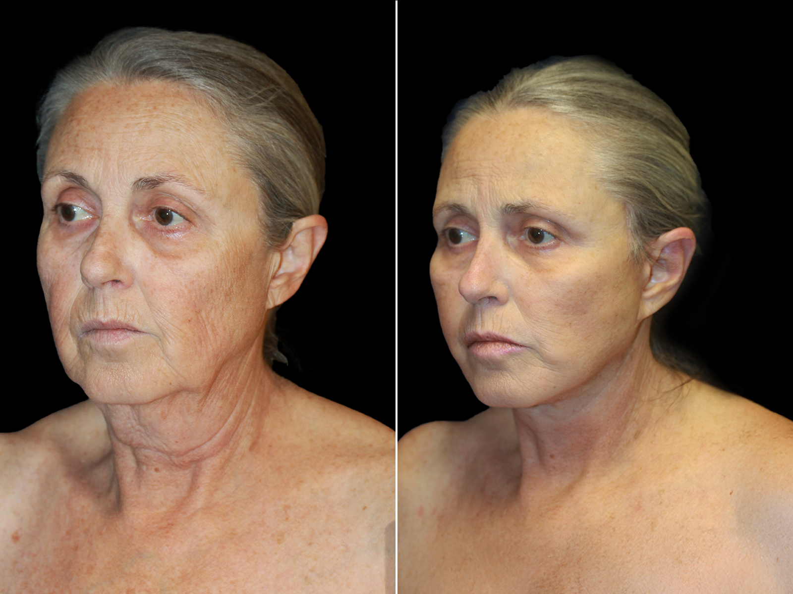 This patient underwent The UpLyft™ facelift combined with a platysmaplasty.
