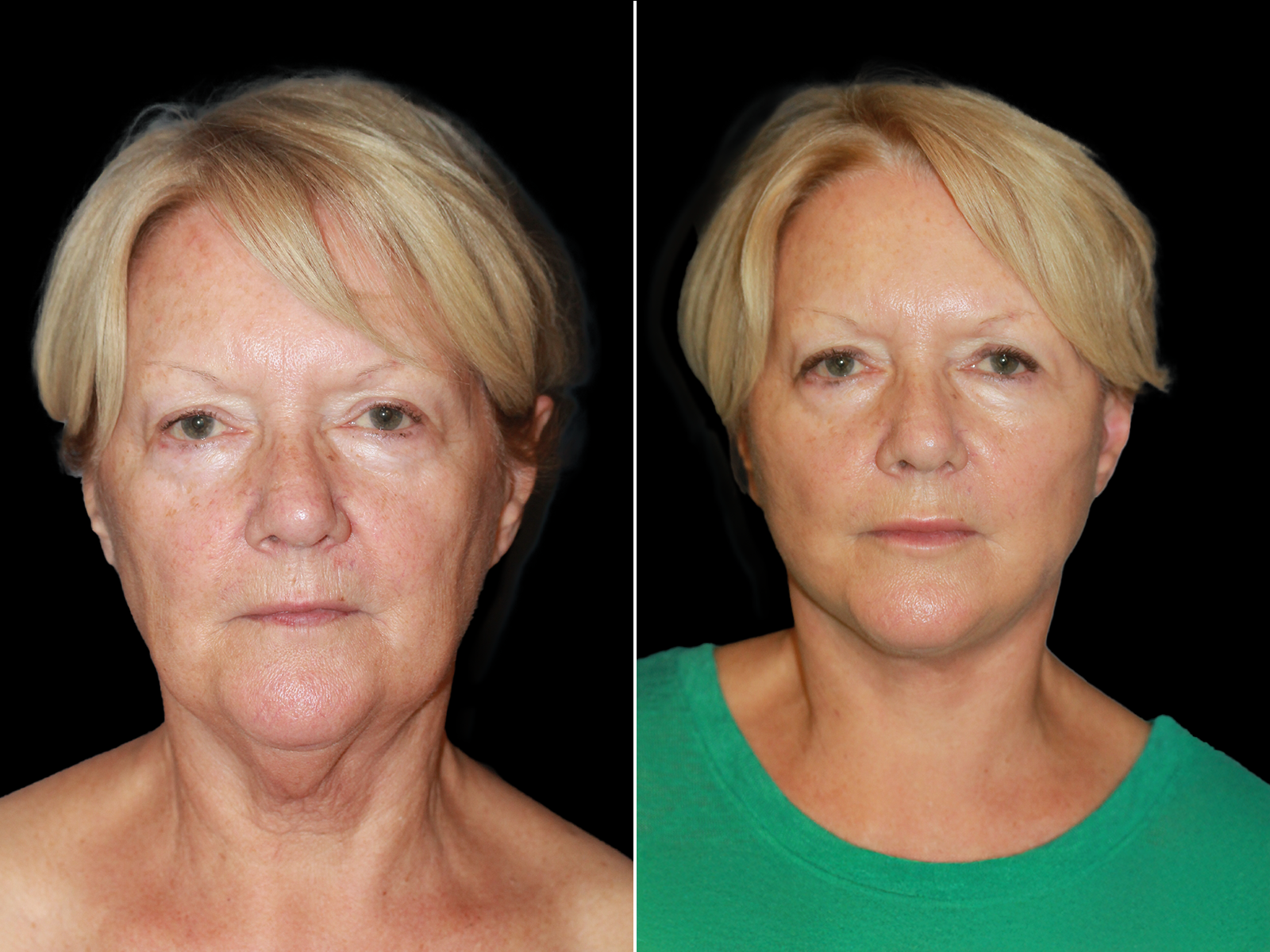This patient underwent The UpLyft™ facelift combined with a platysmaplasty.