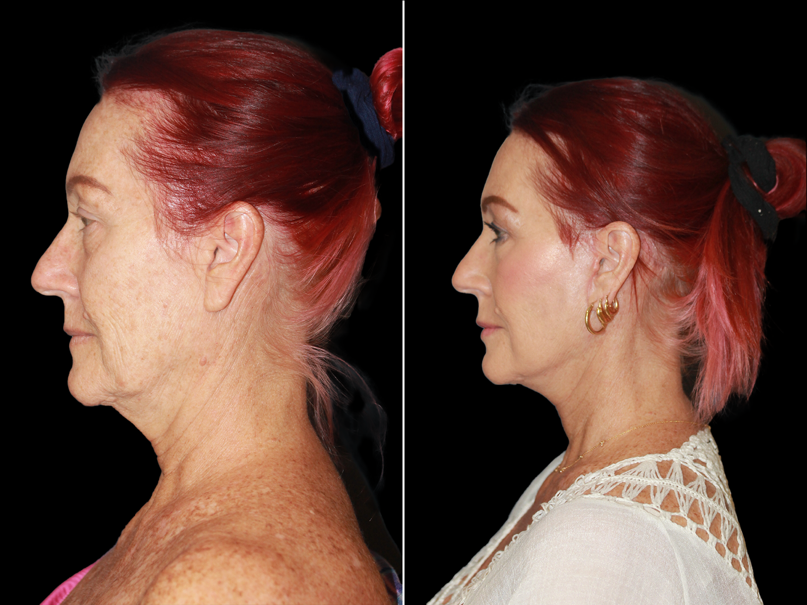 This patient underwent The UpLyft™ facelift combined with a quad blepharoplasty, platysmaplasty, botox, and fat transfer to the lips.