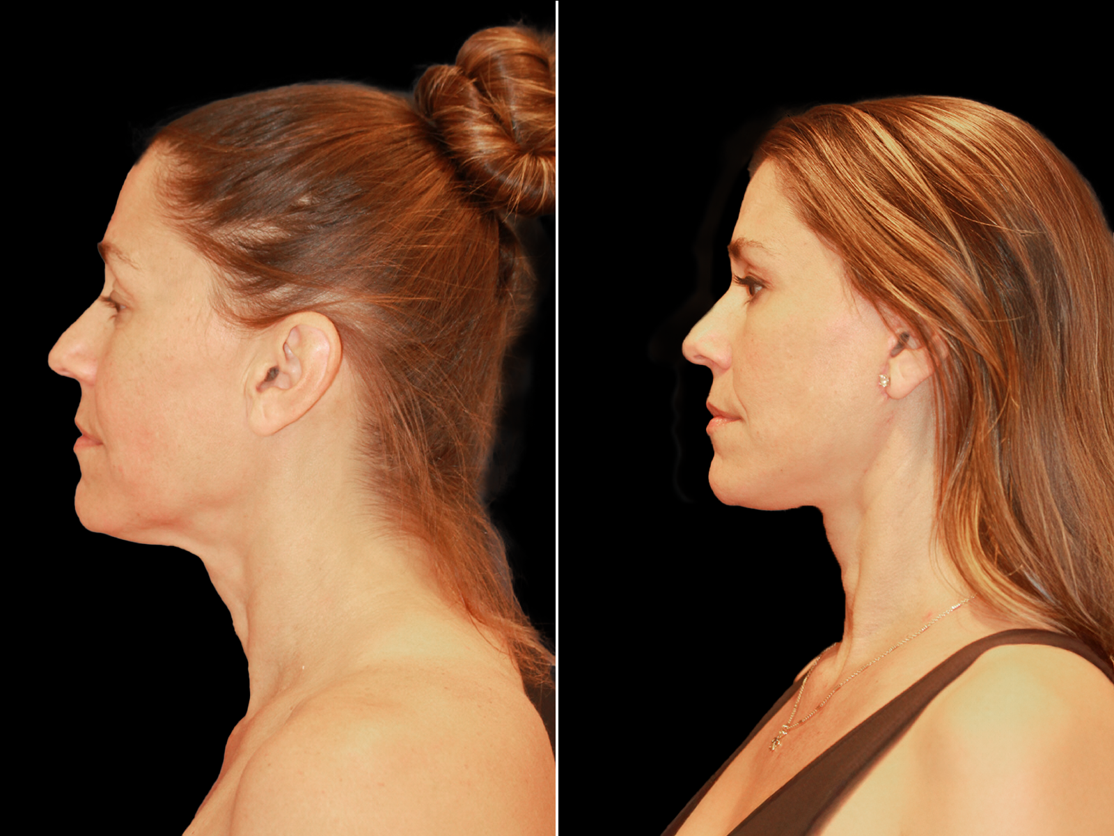 This patient underwent The UpLyft™ facelift combined with an upper blepharoplasty and temporal brow lift.