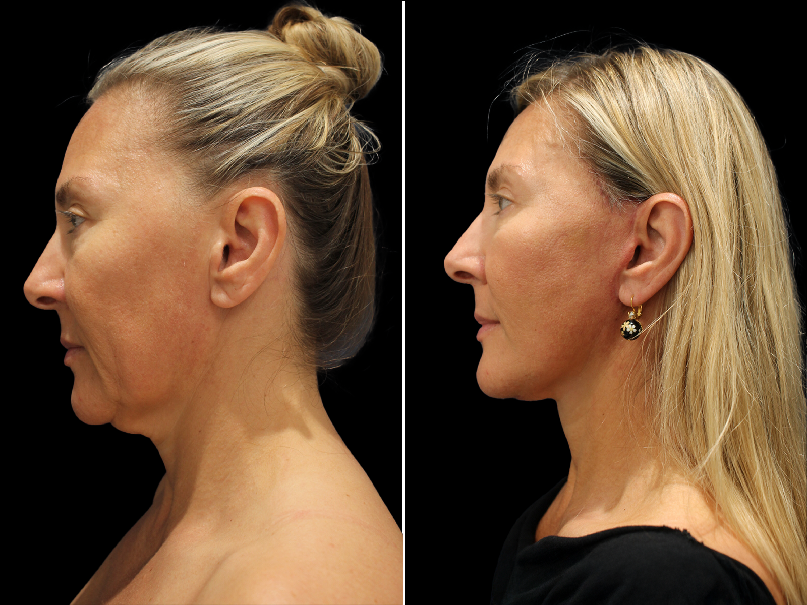 This patient underwent The UpLyft™ facelift combined with an upper blepharoplasty, platysmaplasty, and temporal brow lift.