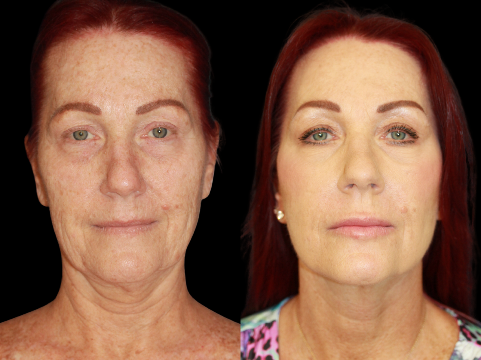 This patient underwent The UpLyft™ facelift combined with a quad blepharoplasty, platysmaplasty, botox, and fat transfer to the lips.