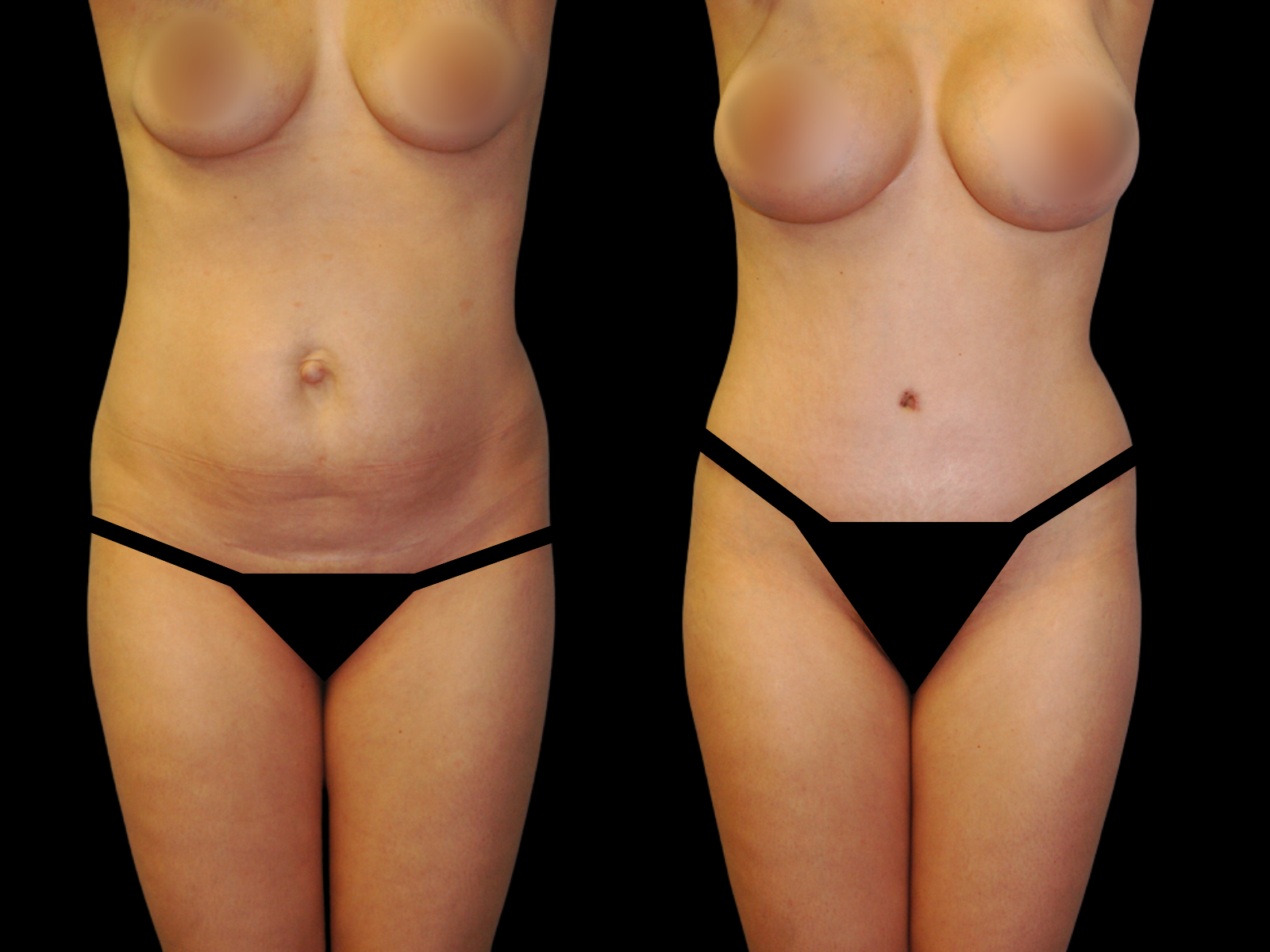 This patient underwent a Mommy Makeover procedure that included a breast augmentation, Bikini Tummy Tuck™, hernia repair, and liposuction of the waist and back.