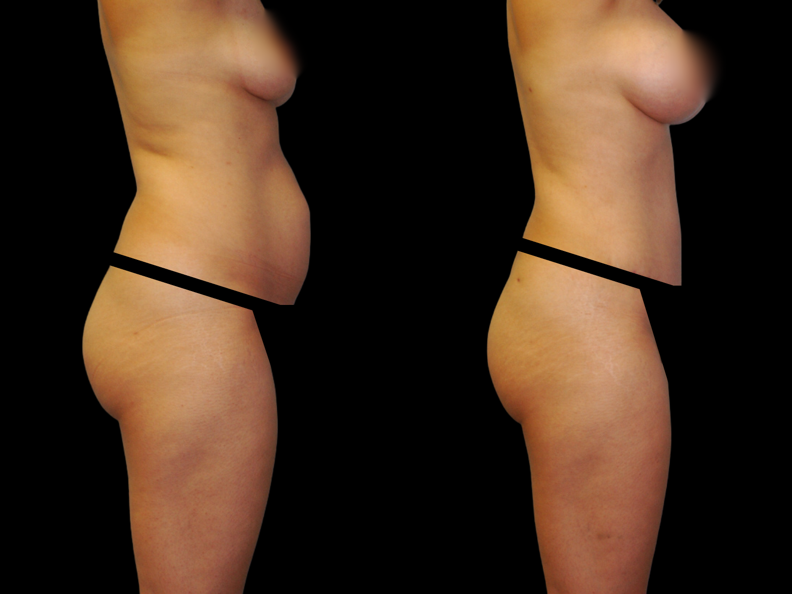 This patient underwent a Mommy Makeover procedure that included a breast augmentation, Bikini Tummy Tuck™, hernia repair, and liposuction of the waist and back.