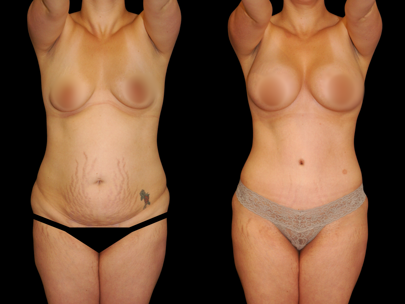 This patient underwent a Mommy Makeover procedure that included a breast augmentation, Bikini Tummy Tuck™, and liposuction of the waist and back.