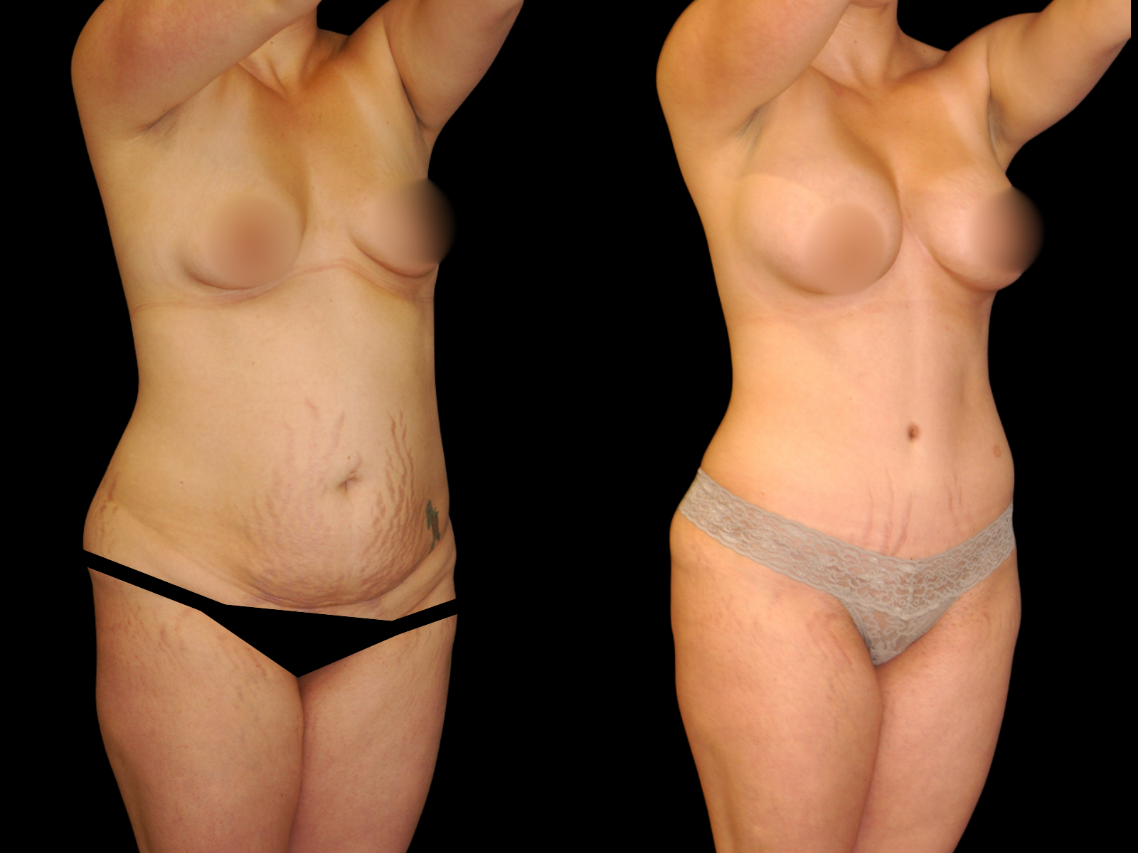 This patient underwent a Mommy Makeover procedure that included a breast augmentation, Bikini Tummy Tuck™, and liposuction of the waist and back.