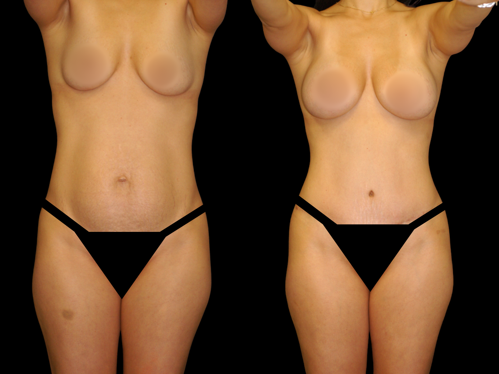 This patient underwent a Mommy Makeover procedure that included a breast augmentation, Bikini Tummy Tuck™, hernia repair, and liposuction of the waist and back.