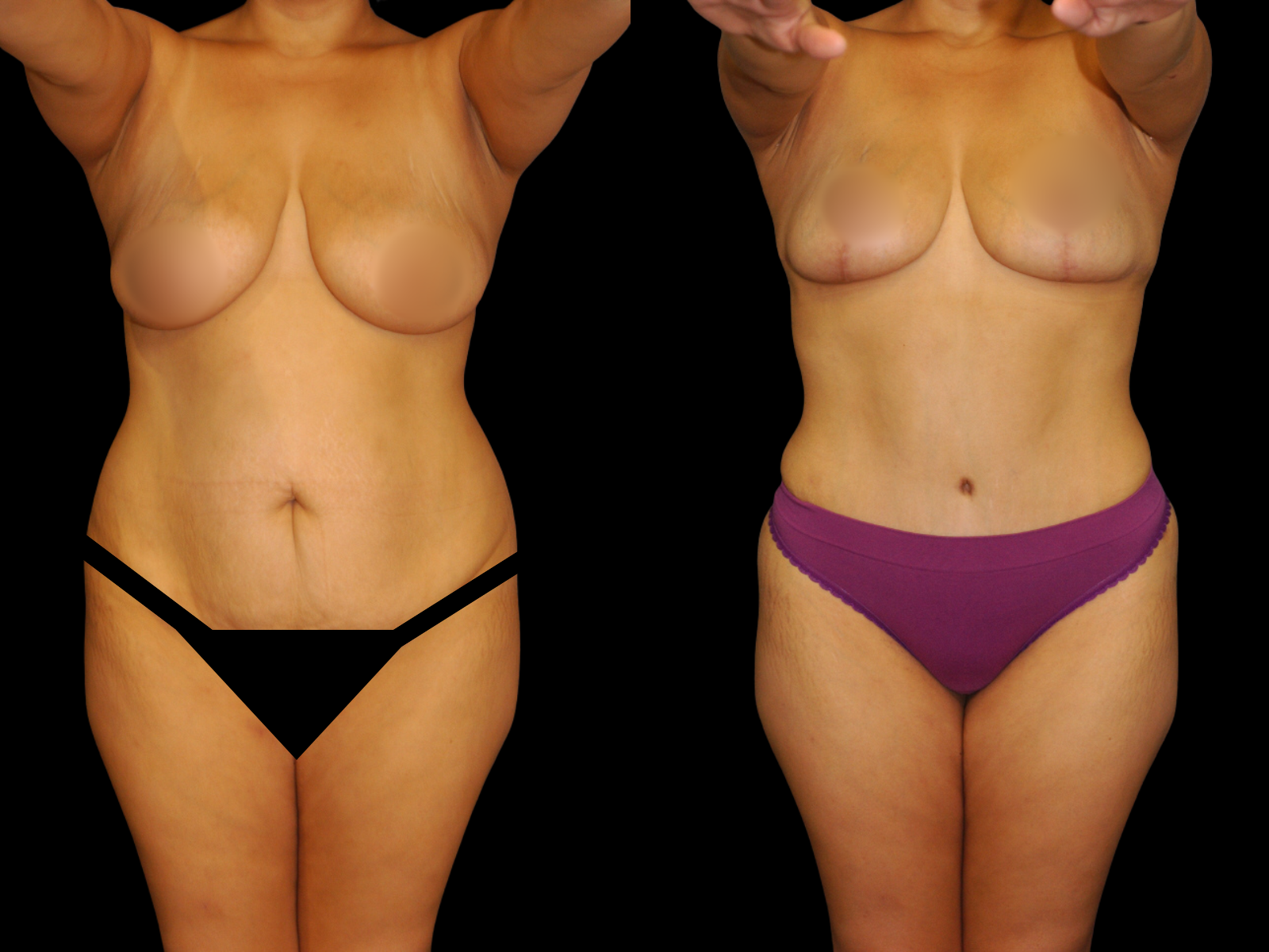 This patient underwent a Mommy Makeover procedure that included a breast lift, extended Bikini Tummy Tuck™, and liposuction of the waist and back.