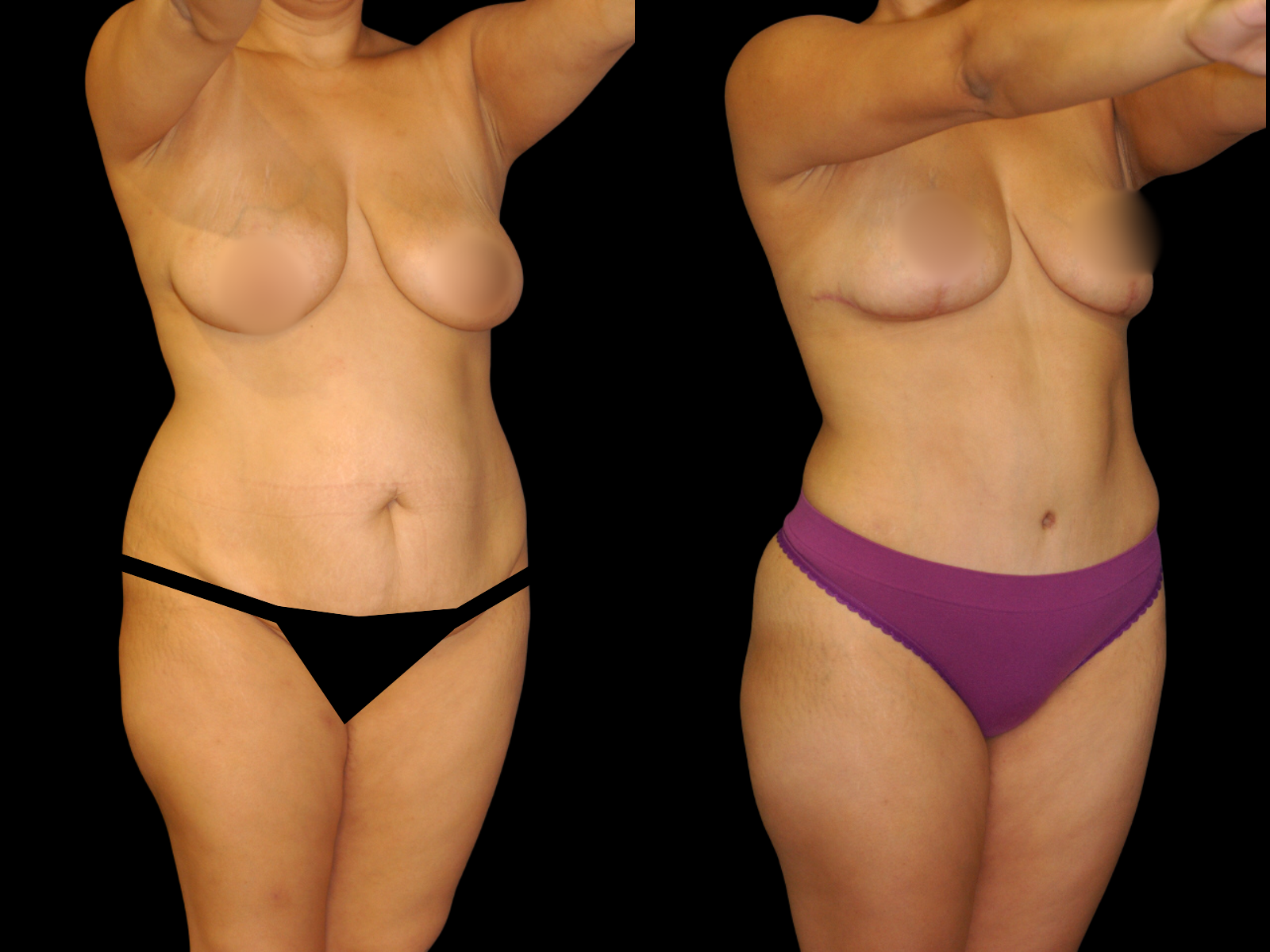 This patient underwent a Mommy Makeover procedure that included a breast lift, extended Bikini Tummy Tuck™, and liposuction of the waist and back.
