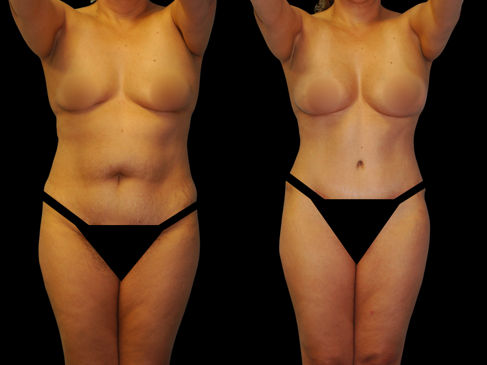 This patient underwent a Mommy Makeover procedure that included a breast augmentation, Bikini Tummy Tuck™, and liposuction of the waist and back.