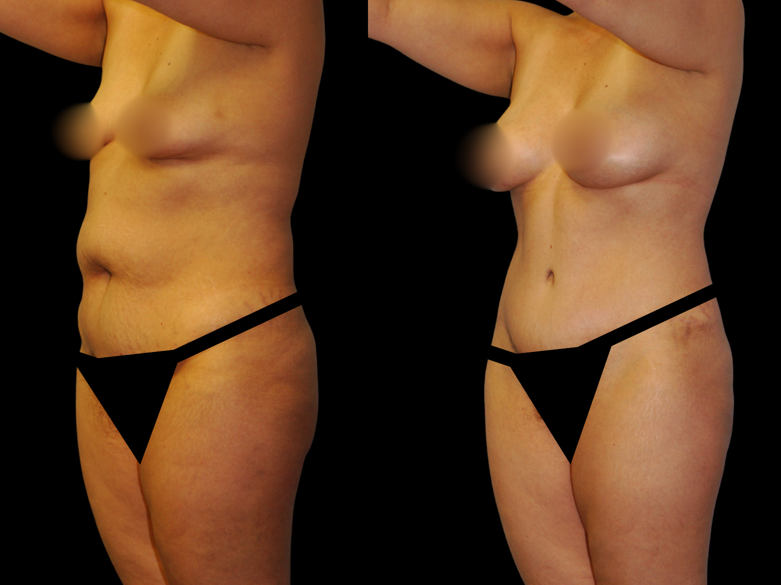 This patient underwent a Mommy Makeover procedure that included a breast augmentation, Bikini Tummy Tuck™, and liposuction of the waist and back.
