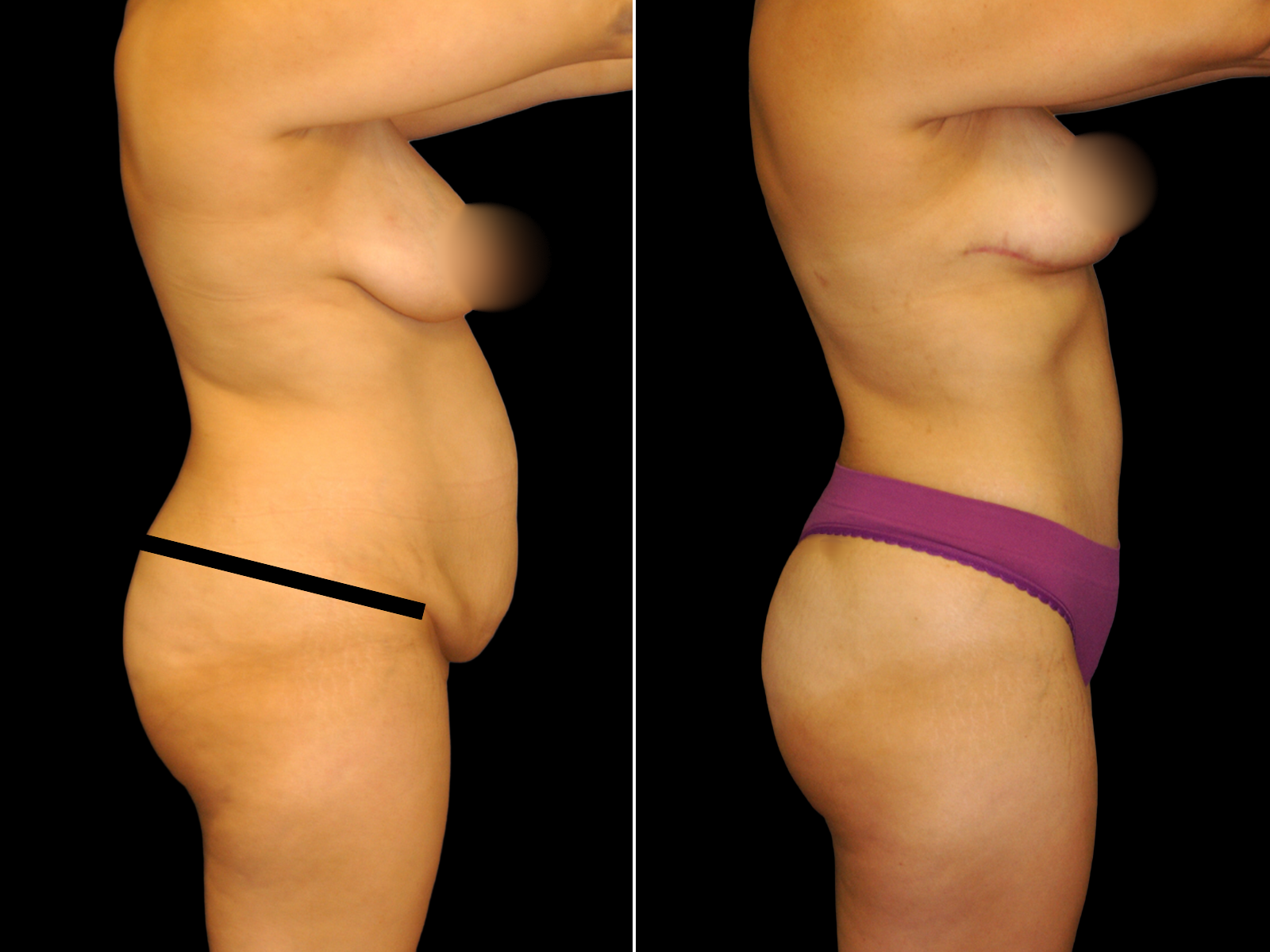 This patient underwent a Mommy Makeover procedure that included a breast lift, extended Bikini Tummy Tuck™, and liposuction of the waist and back.