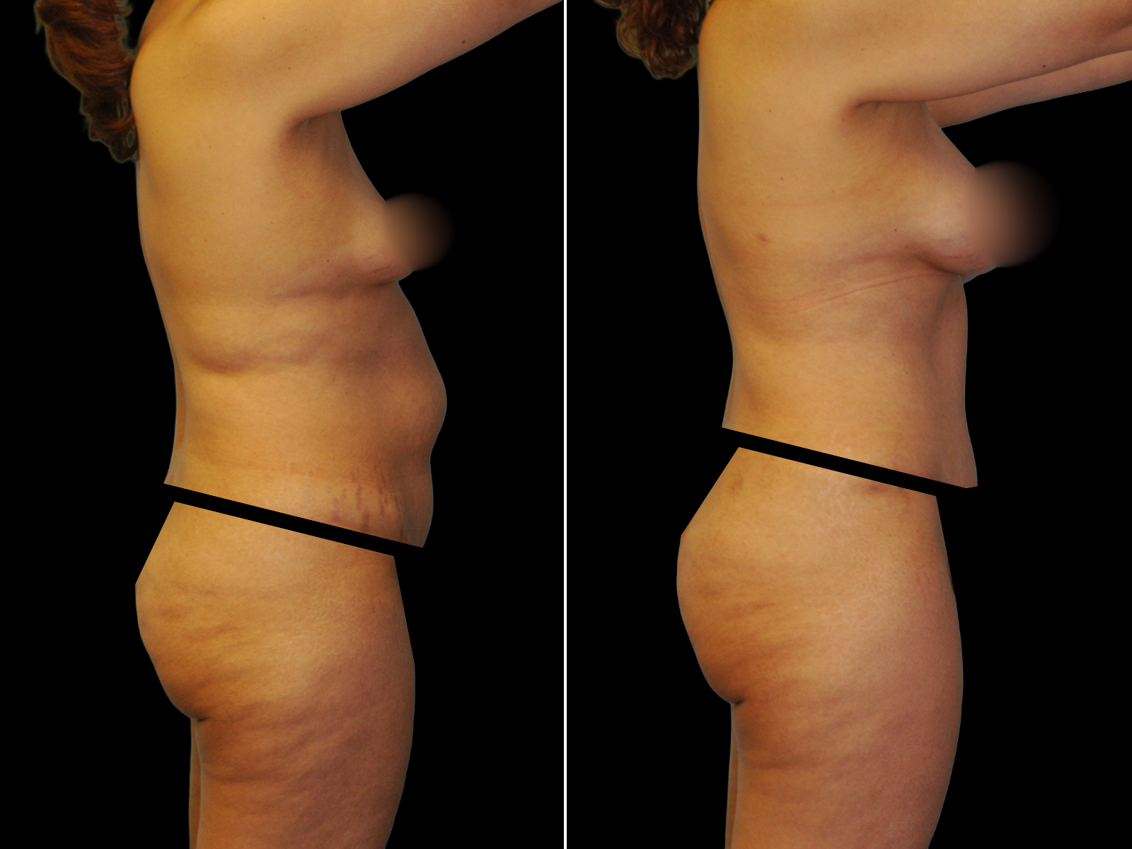 This patient underwent a Mommy Makeover procedure that included a breast augmentation, Bikini Tummy Tuck™, and liposuction of the waist and back.
