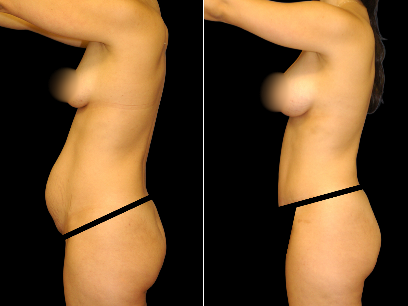This patient underwent a Mommy Makeover procedure that included a breast augmentation, Bikini Tummy Tuck™, and liposuction of the waist and back.