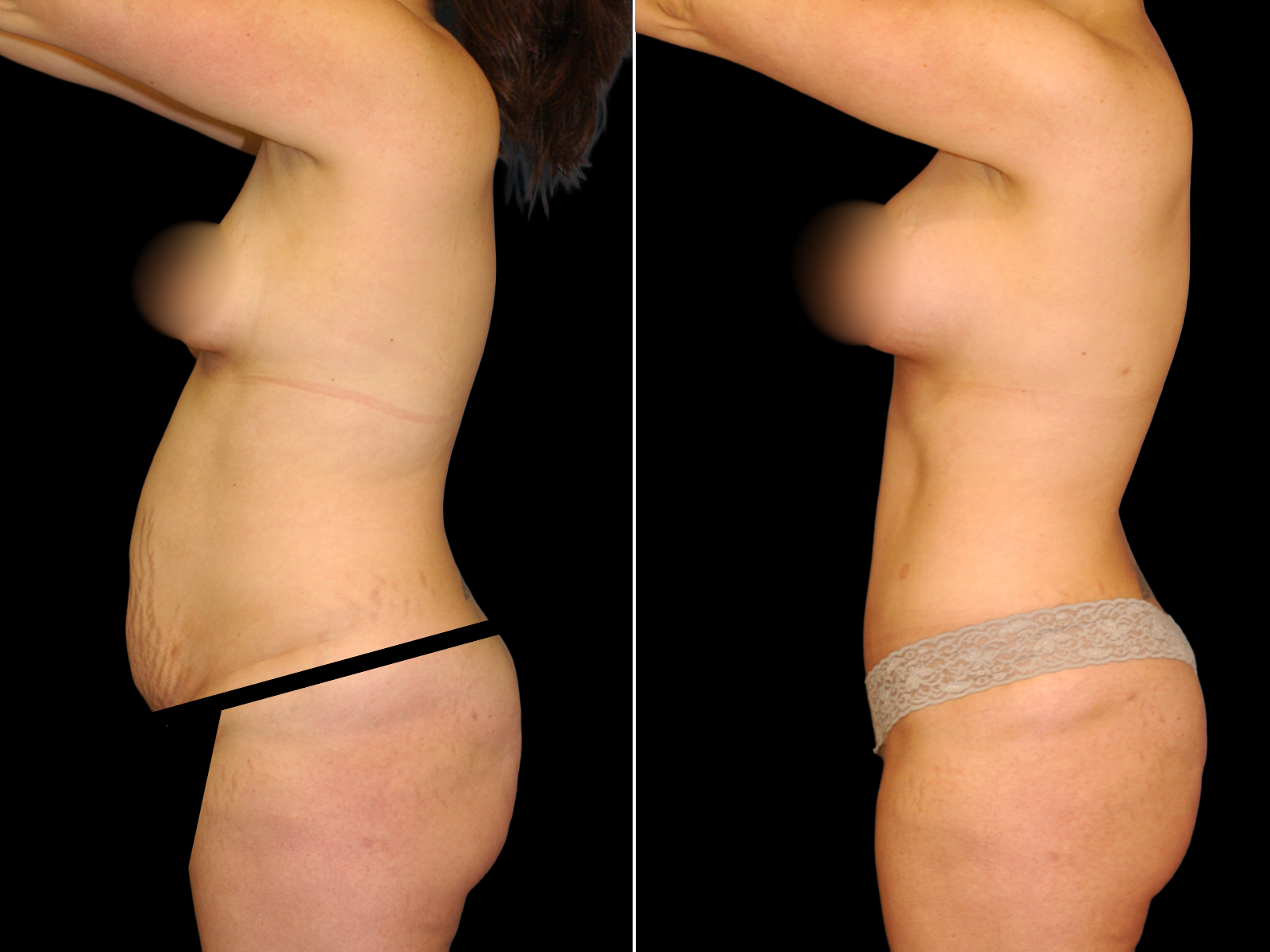 This patient underwent a Mommy Makeover procedure that included a breast augmentation, Bikini Tummy Tuck™, and liposuction of the waist and back.