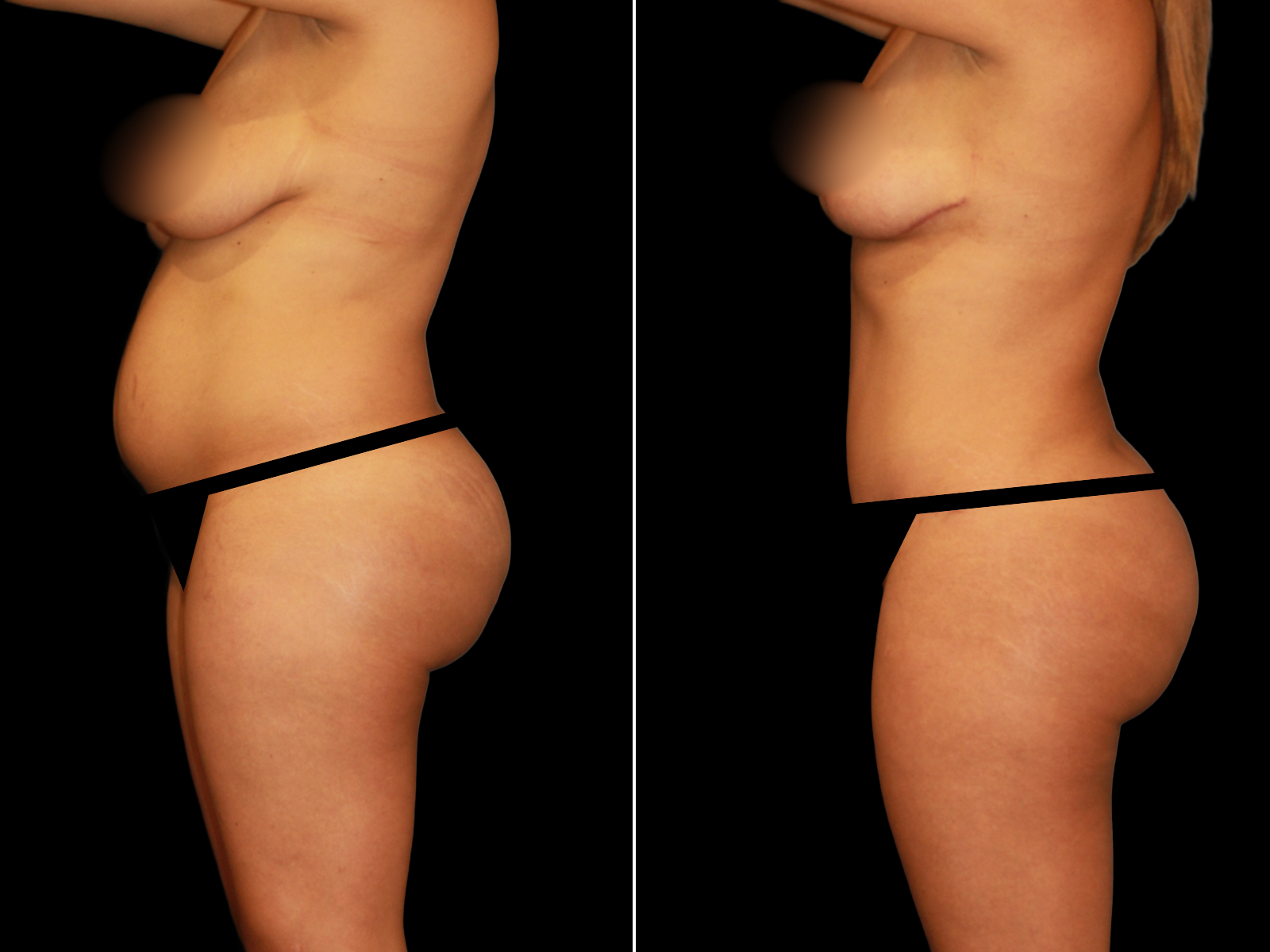 This patient underwent a Mommy Makeover procedure that included a breast augmentation, Bikini Tummy Tuck™, and liposuction of the waist and back.