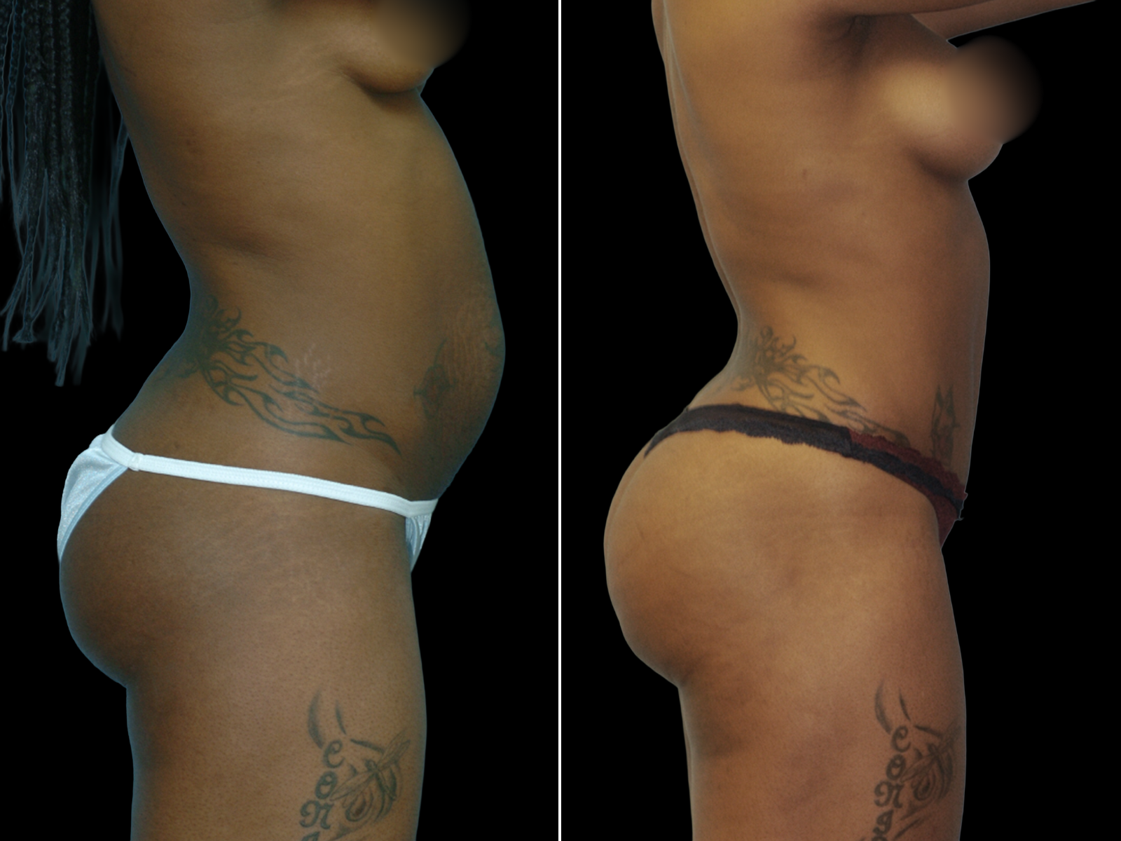 This patient underwent a Mommy Makeover procedure that included a breast augmentation, Bikini Tummy Tuck™, and liposuction of the waist and back.