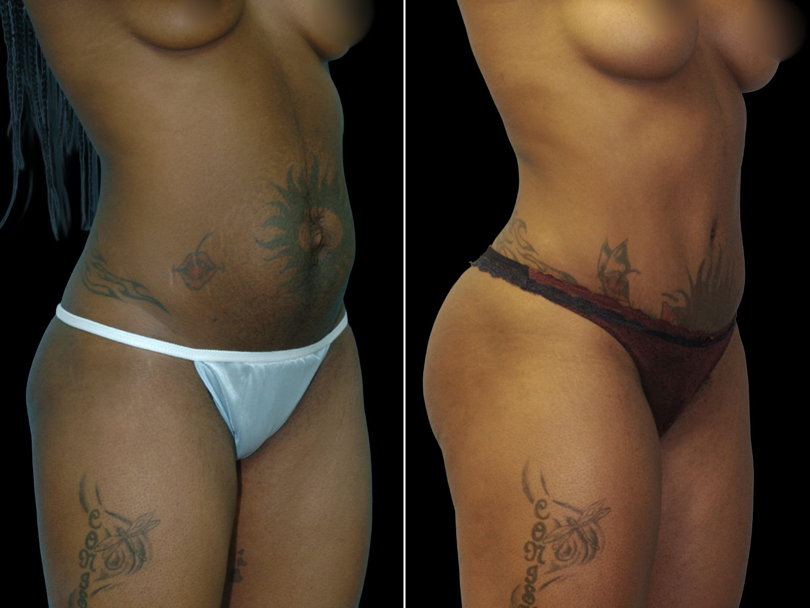 This patient underwent a Mommy Makeover procedure that included a breast augmentation, Bikini Tummy Tuck™, and liposuction of the waist and back.