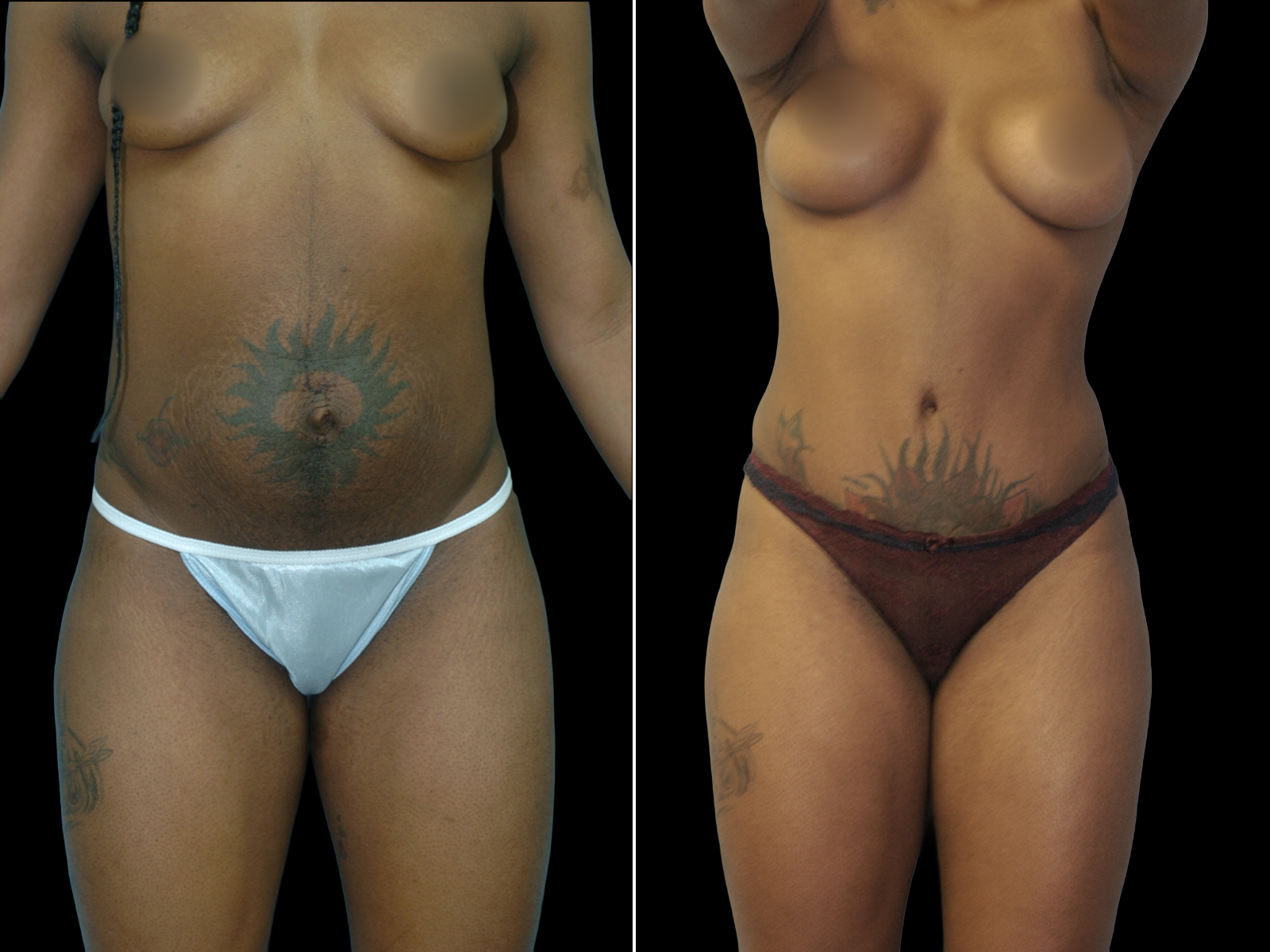 This patient underwent a Mommy Makeover procedure that included a breast augmentation, Bikini Tummy Tuck™, and liposuction of the waist and back.