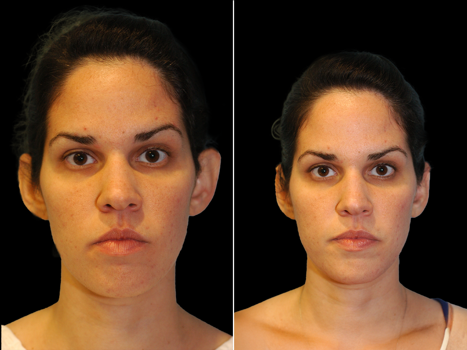 otoplasty-before-and-after-dr-soler-baillo-coral-gables-01