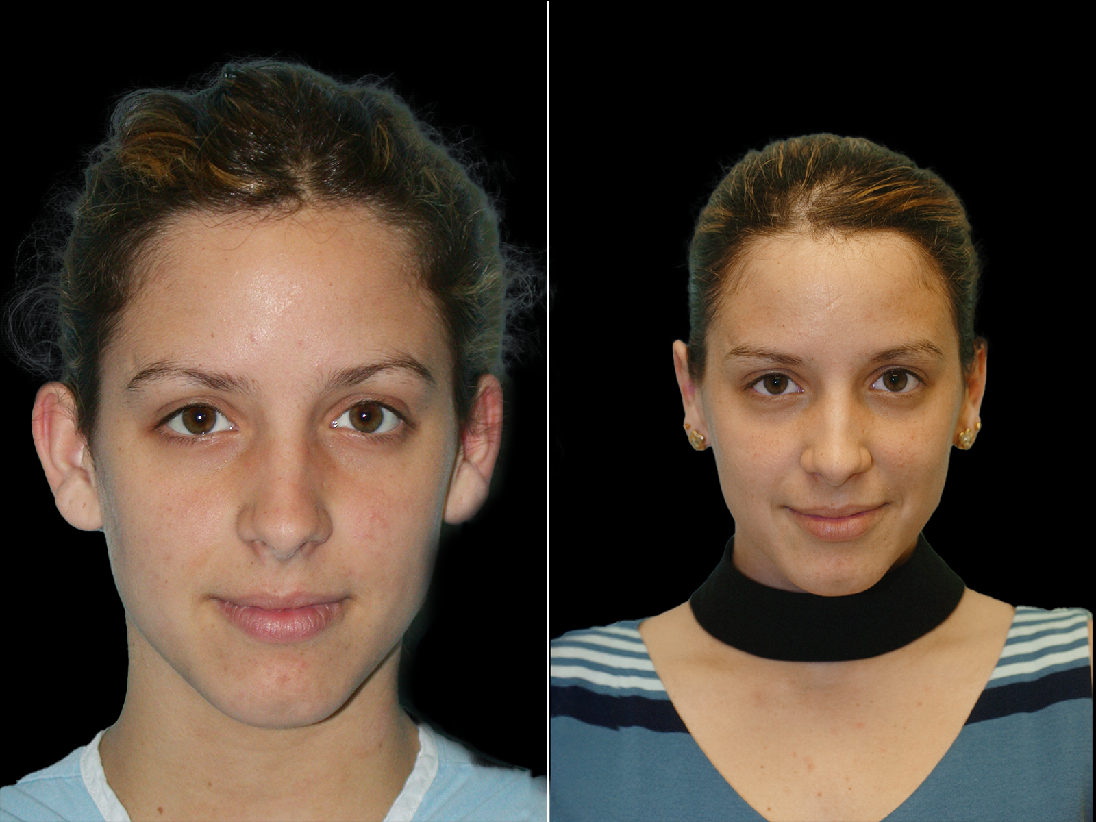 otoplasty-before-and-after-dr-soler-baillo-coral-gables-02