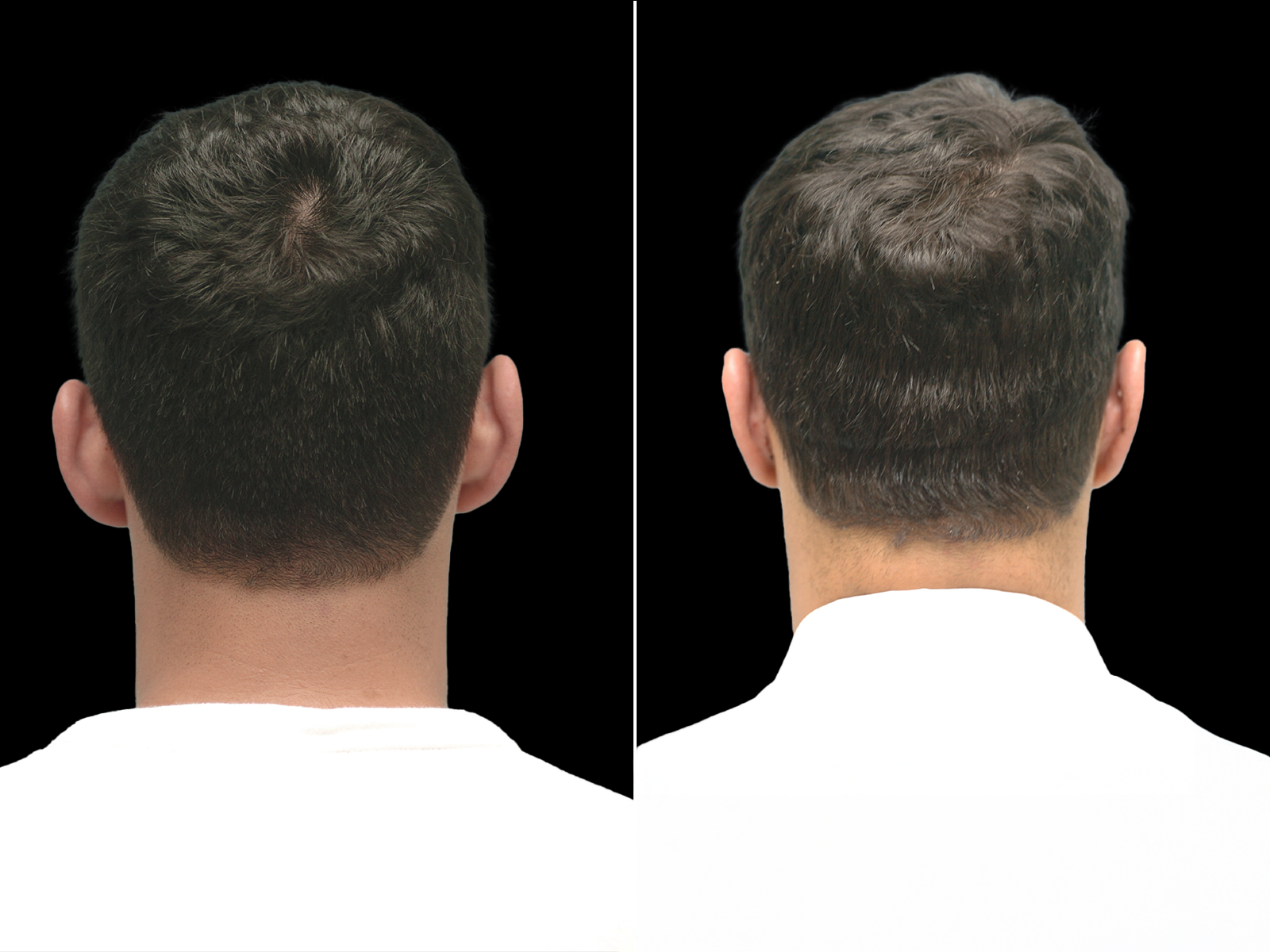 otoplasty-before-and-after-dr-soler-baillo-coral-gables-03