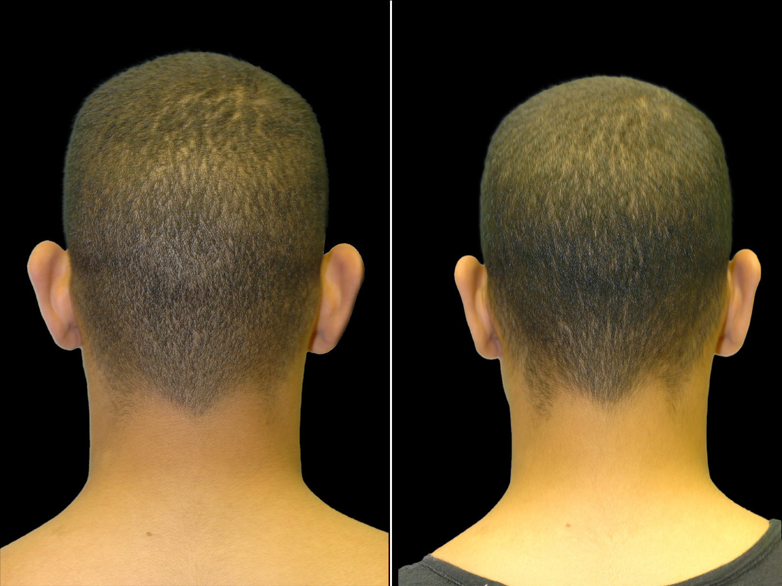 otoplasty-before-and-after-dr-soler-baillo-coral-gables-04