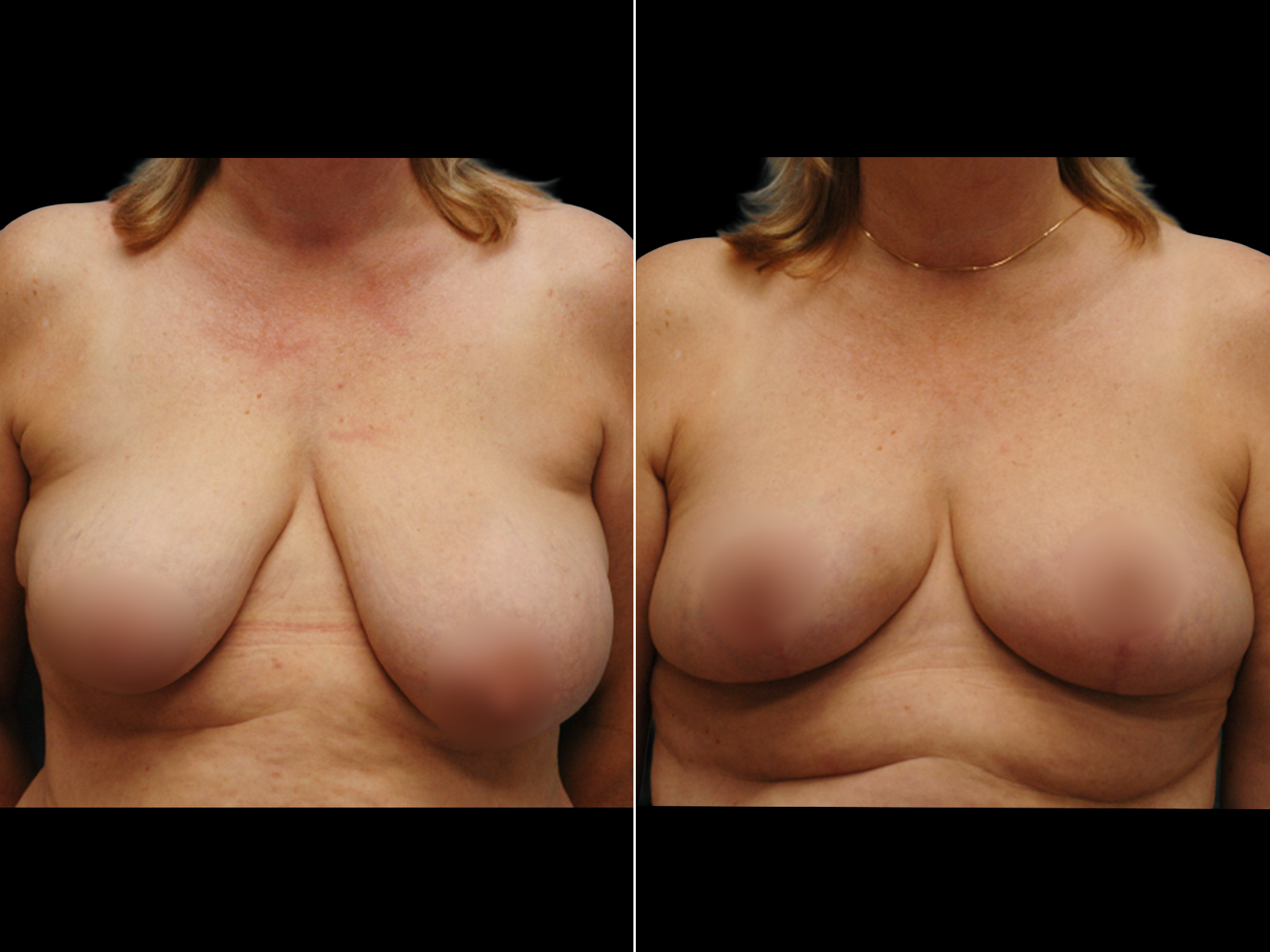 breast-lift-before-and-after-coral-gables-dr-soler-baillo-03