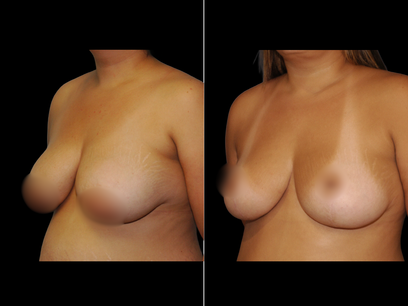 breast-lift-before-and-after-coral-gables-dr-soler-baillo-05