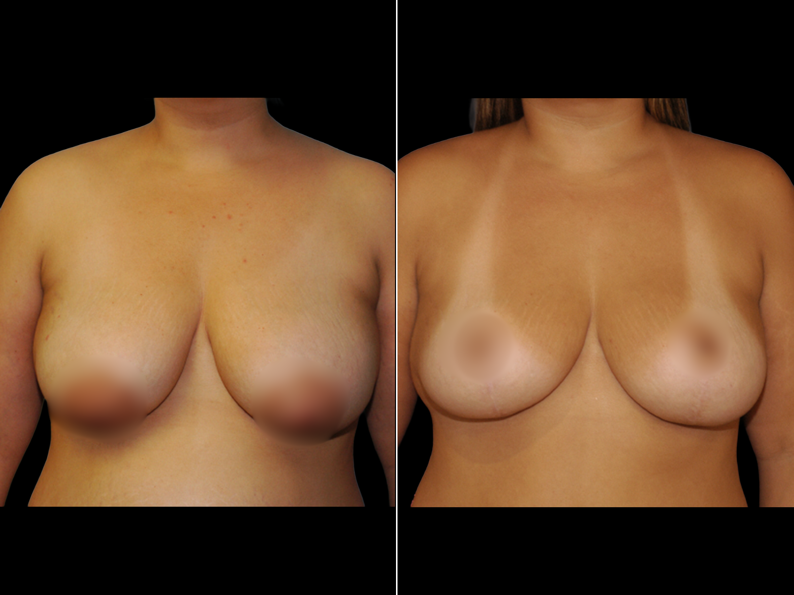 breast-lift-before-and-after-coral-gables-dr-soler-baillo-06