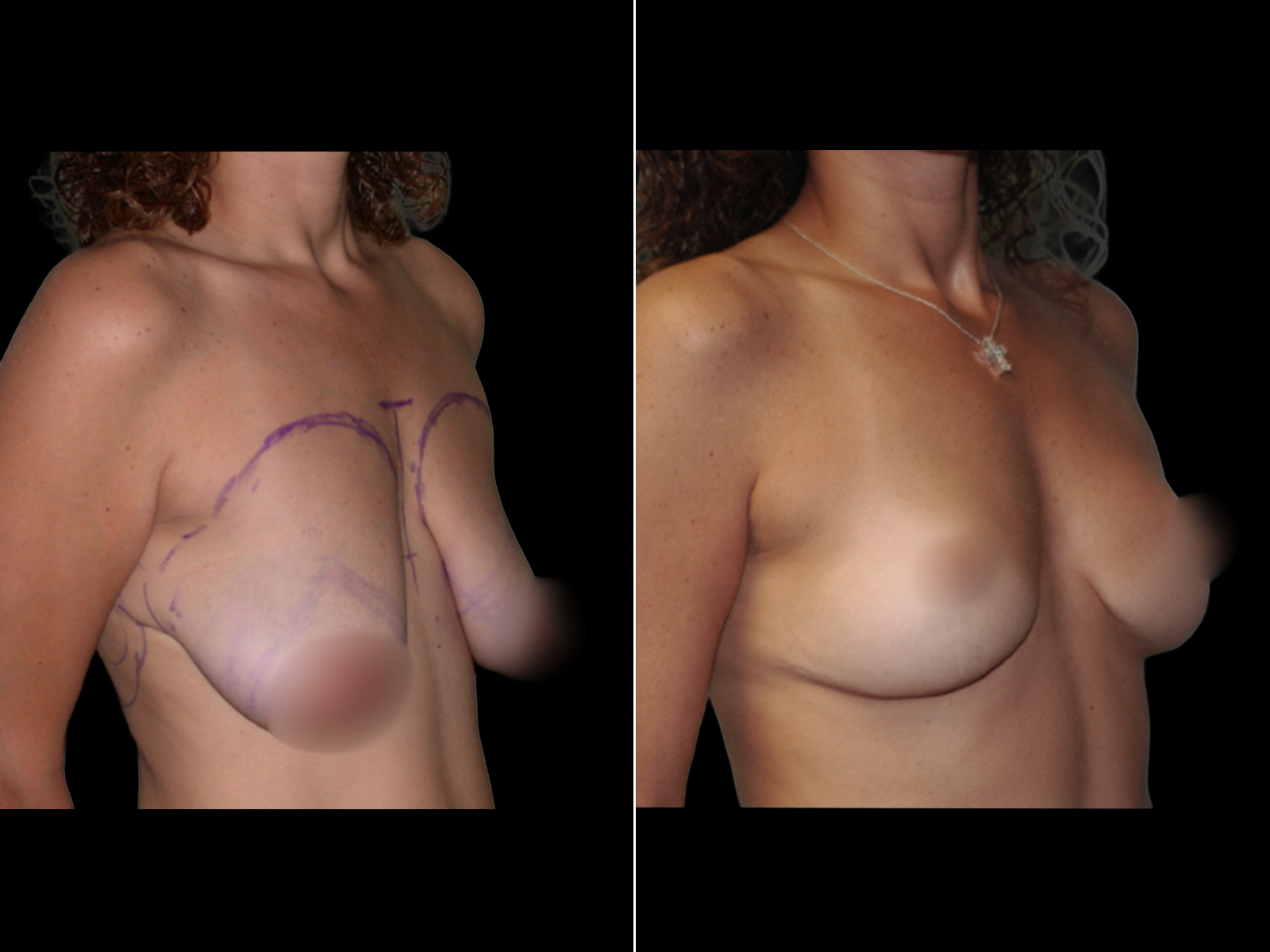 breast-lift-before-and-after-coral-gables-dr-soler-baillo-07