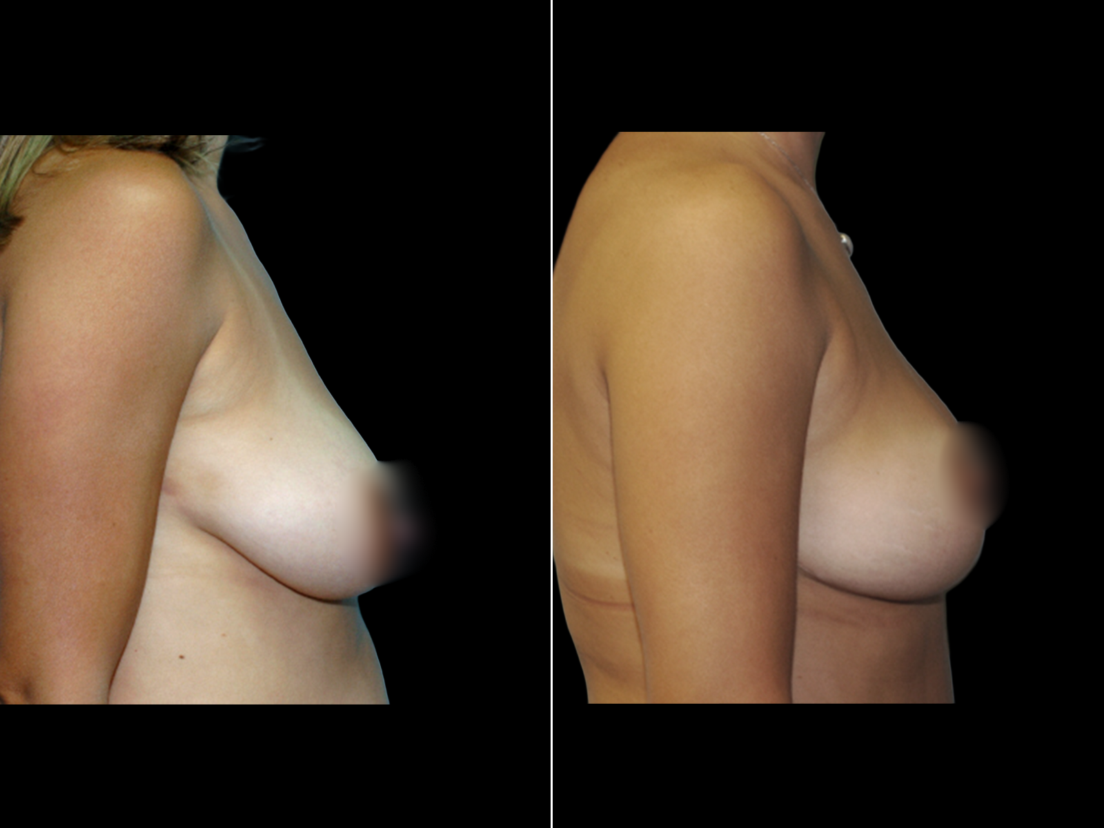 breast-lift-before-and-after-coral-gables-dr-soler-baillo-08