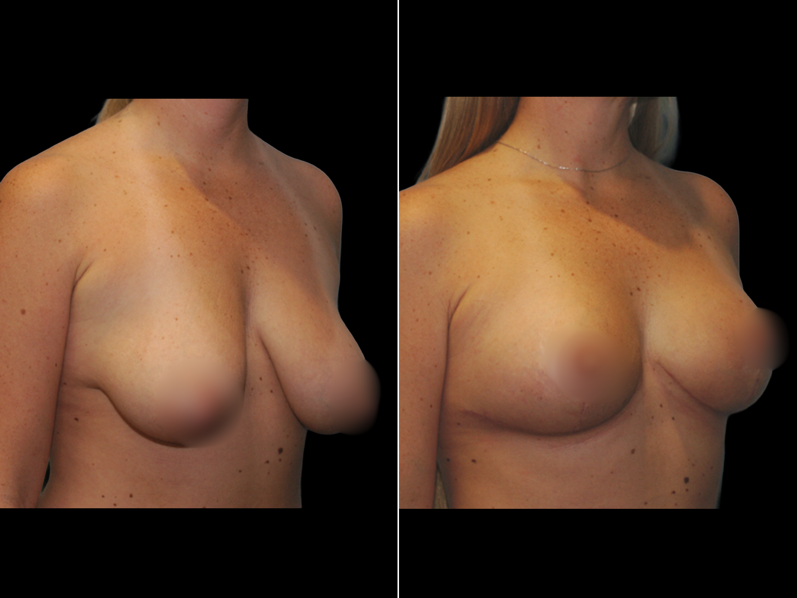 breast-lift-before-and-after-coral-gables-dr-soler-baillo-10