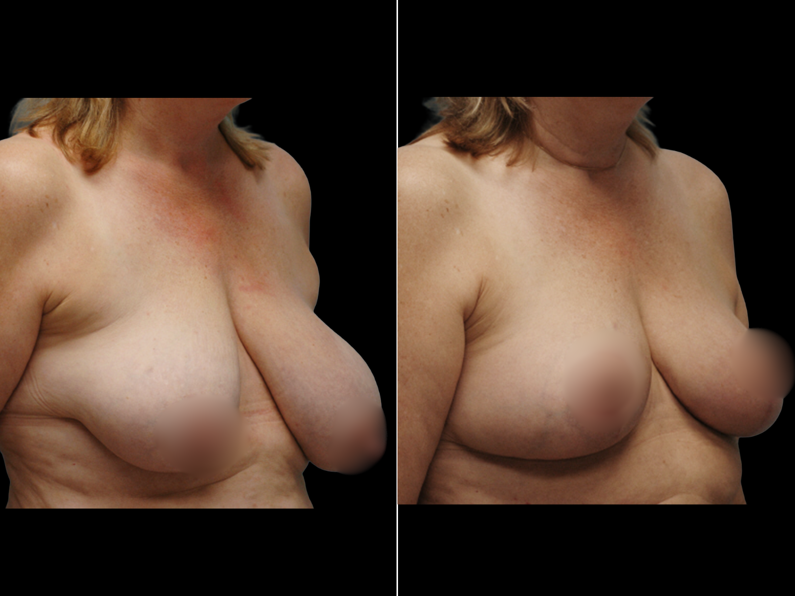 breast-lift-before-and-after-dr-soler-baillo-coral-gables-01