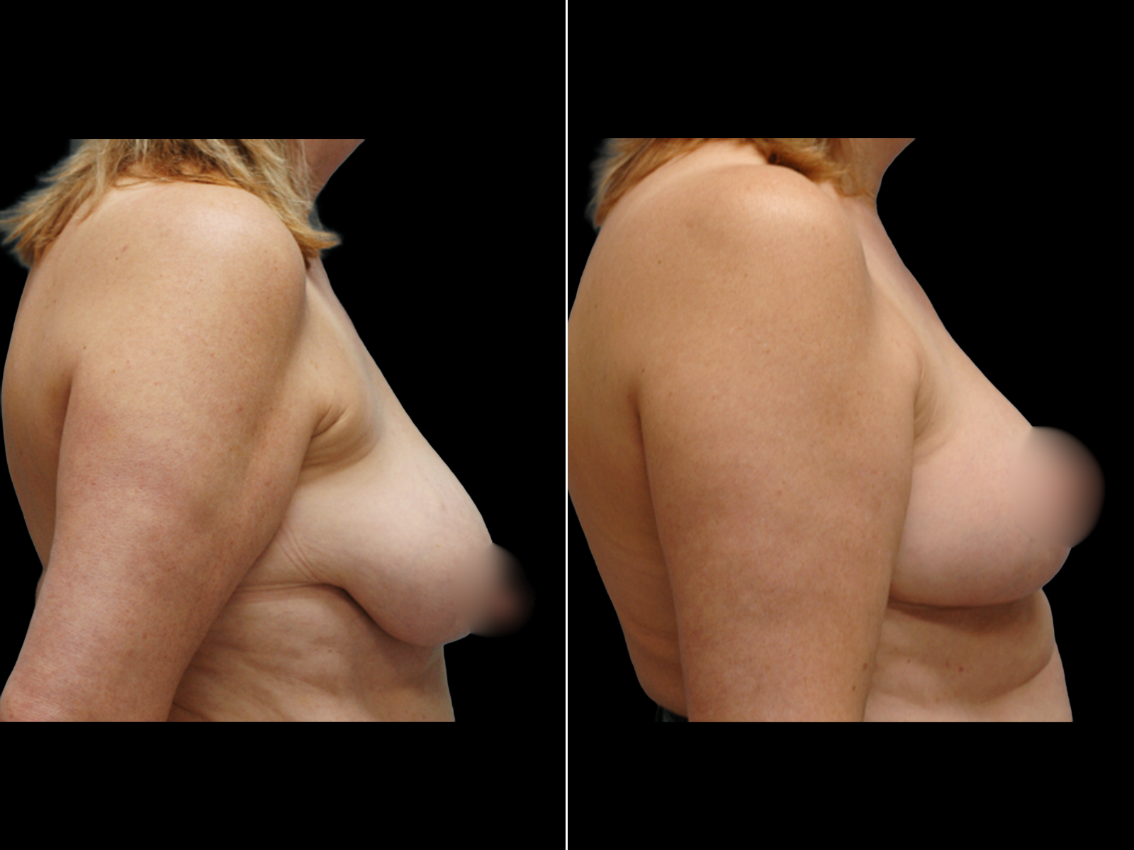 breast-lift-before-and-after-dr-soler-baillo-coral-gables-02