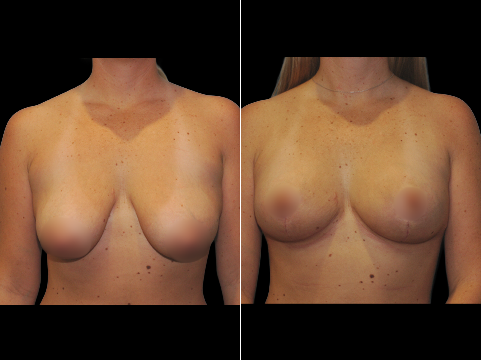 breast-lift-before-and-after-dr-soler-baillo-coral-gables-11