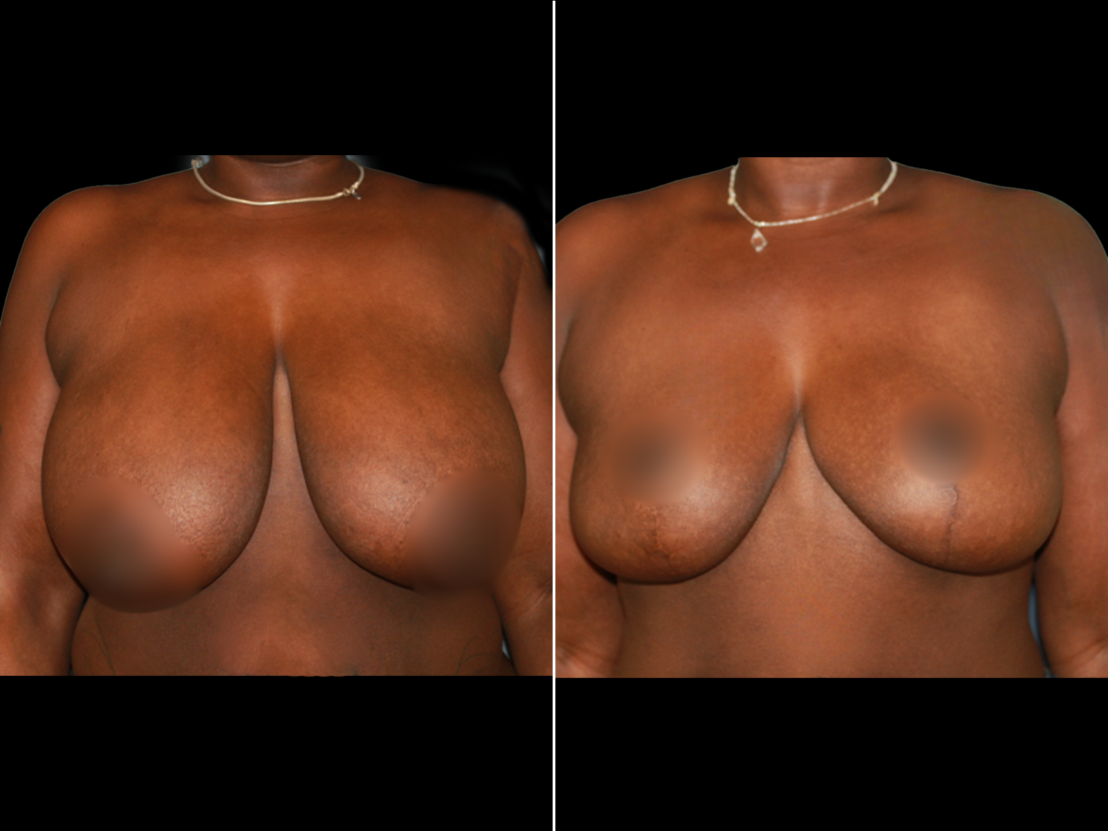 breast-reduction-before-and-after-dr-soler-baillo-coral-gables-01 (1)