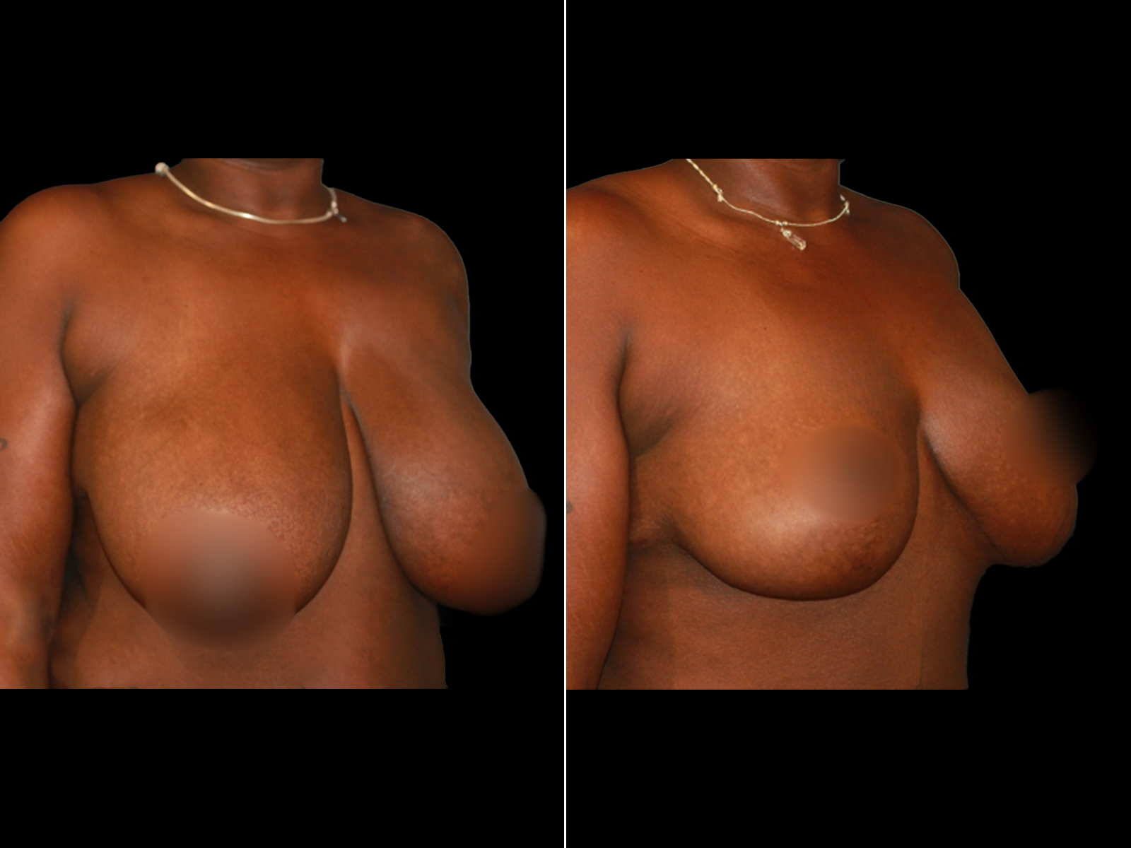 breast-reduction-before-and-after-dr-soler-baillo-coral-gables-02 (1)