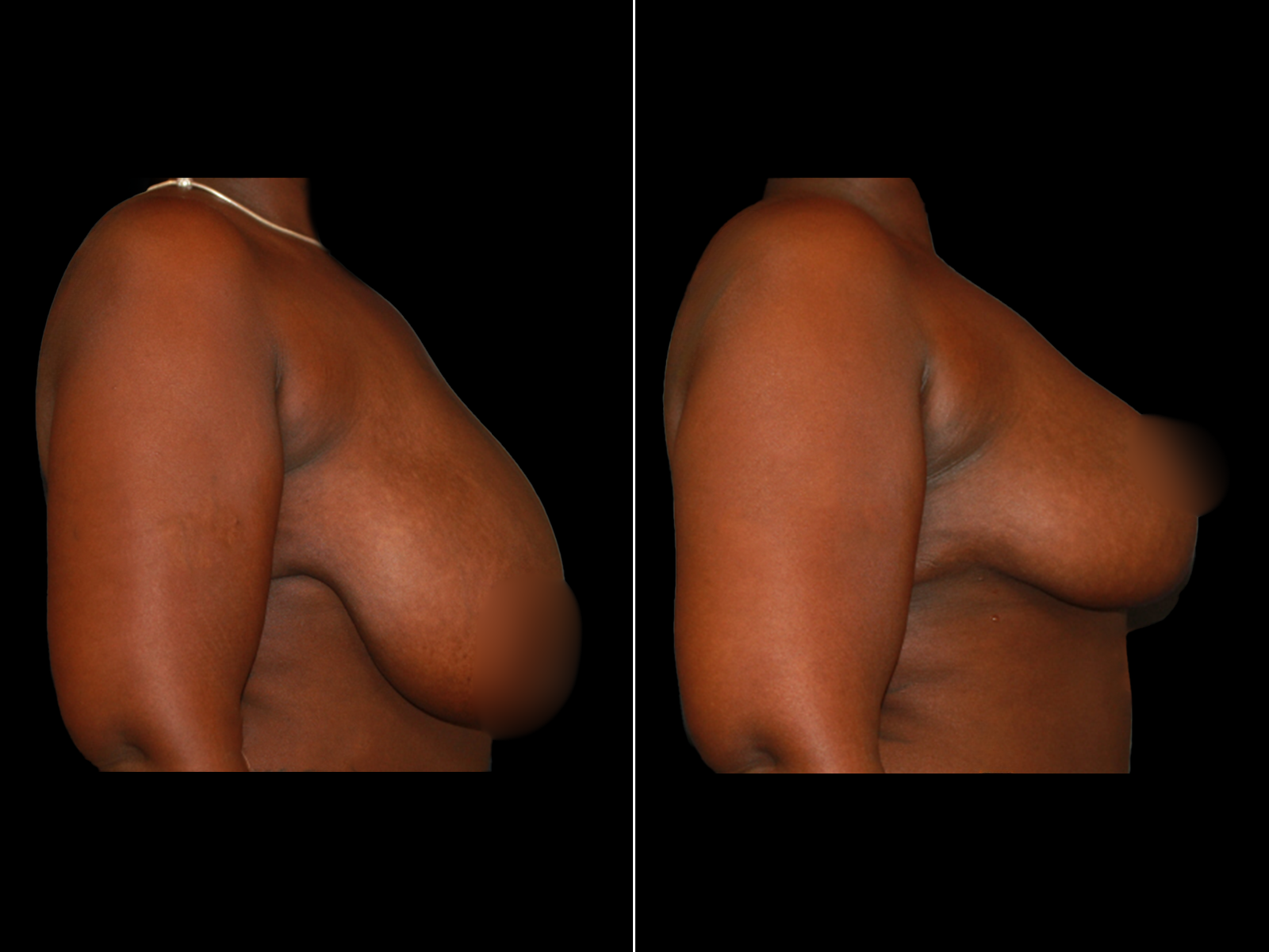 breast-reduction-before-and-after-dr-soler-baillo-coral-gables-03 (1)