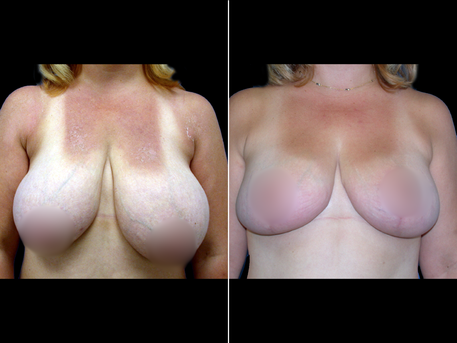 breast-reduction-before-and-after-dr-soler-baillo-coral-gables-04
