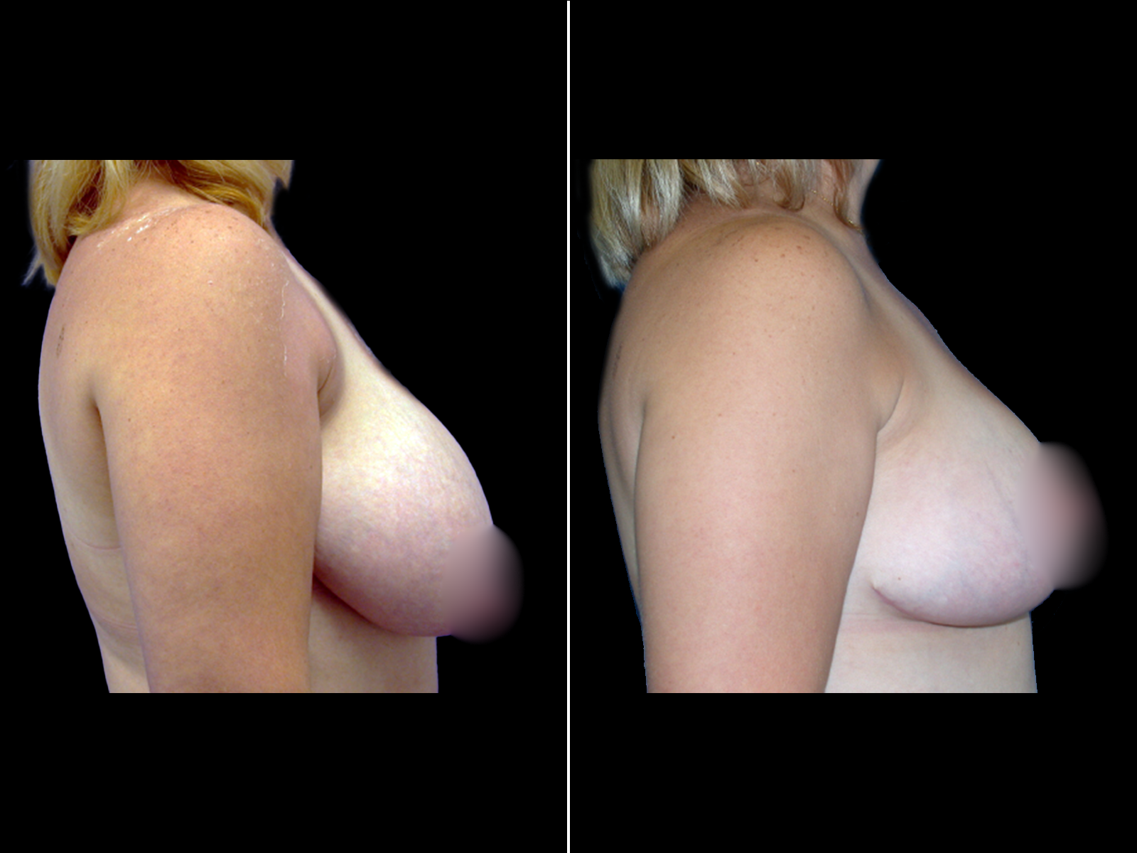 breast-reduction-before-and-after-dr-soler-baillo-coral-gables-06 (1)