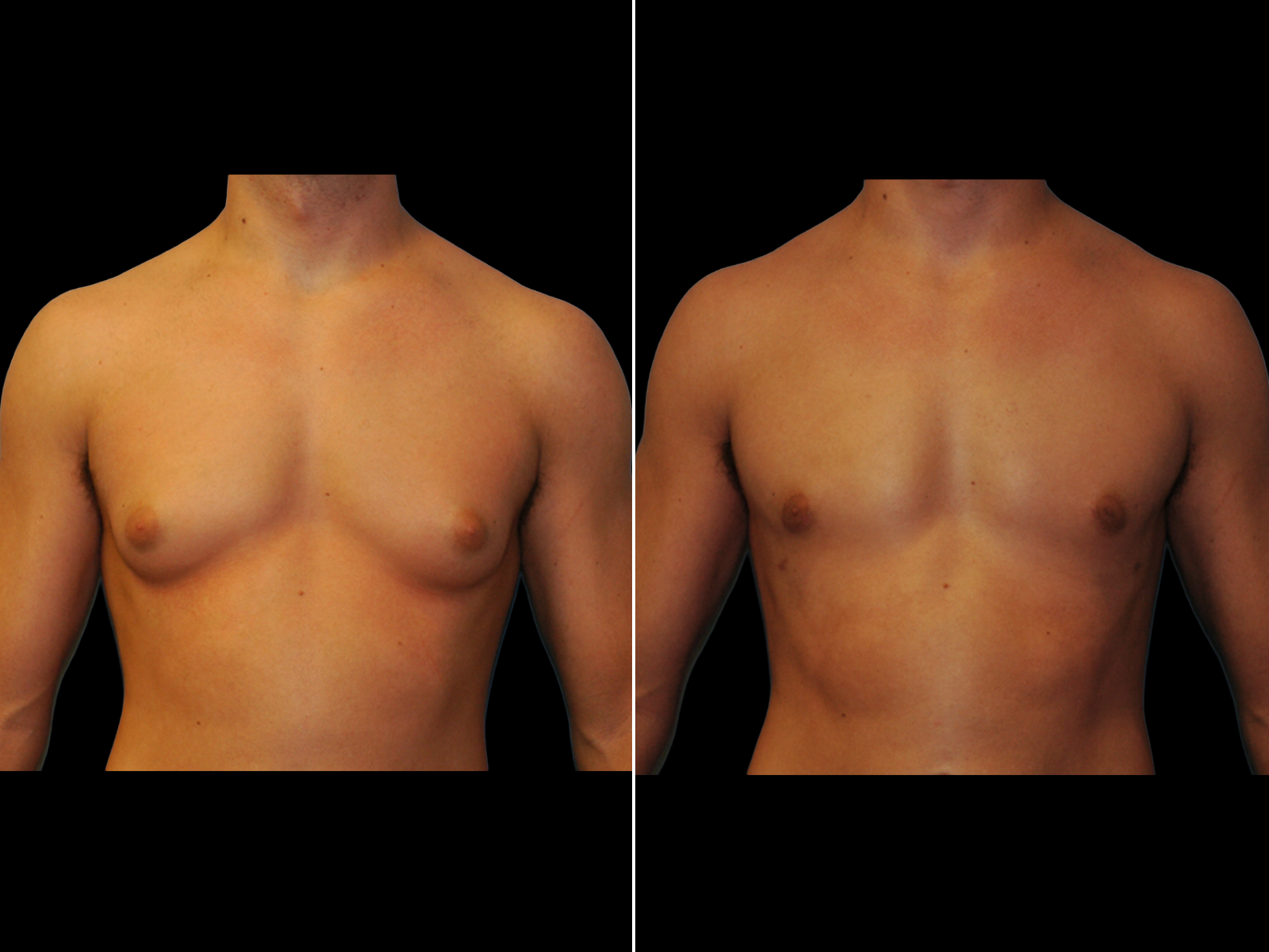 Gynecomastia A1