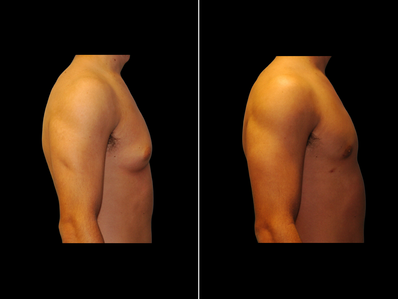 Gynecomastia A2