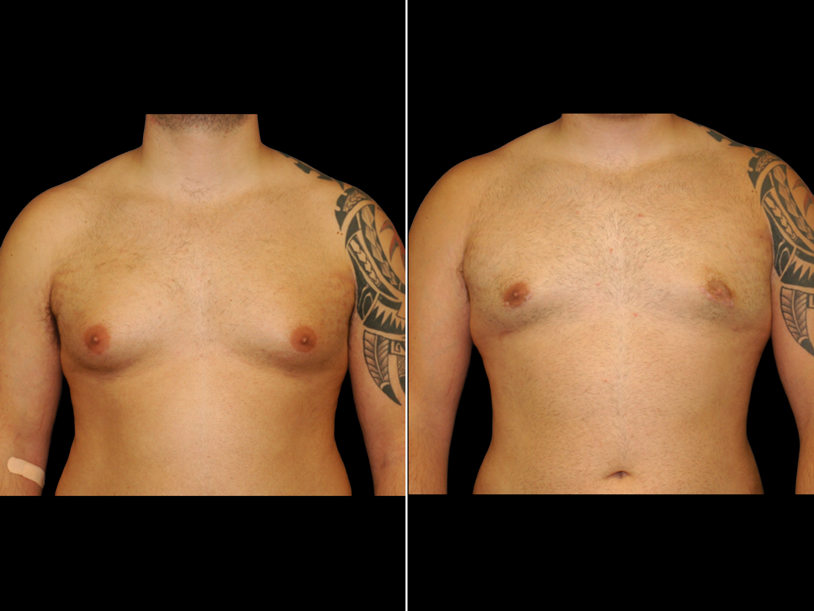 Gynecomastia B1