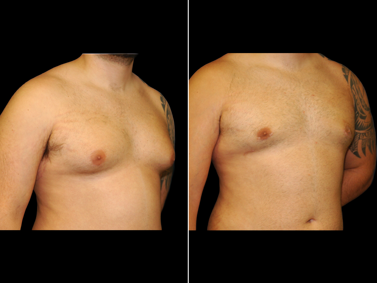 Gynecomastia B2