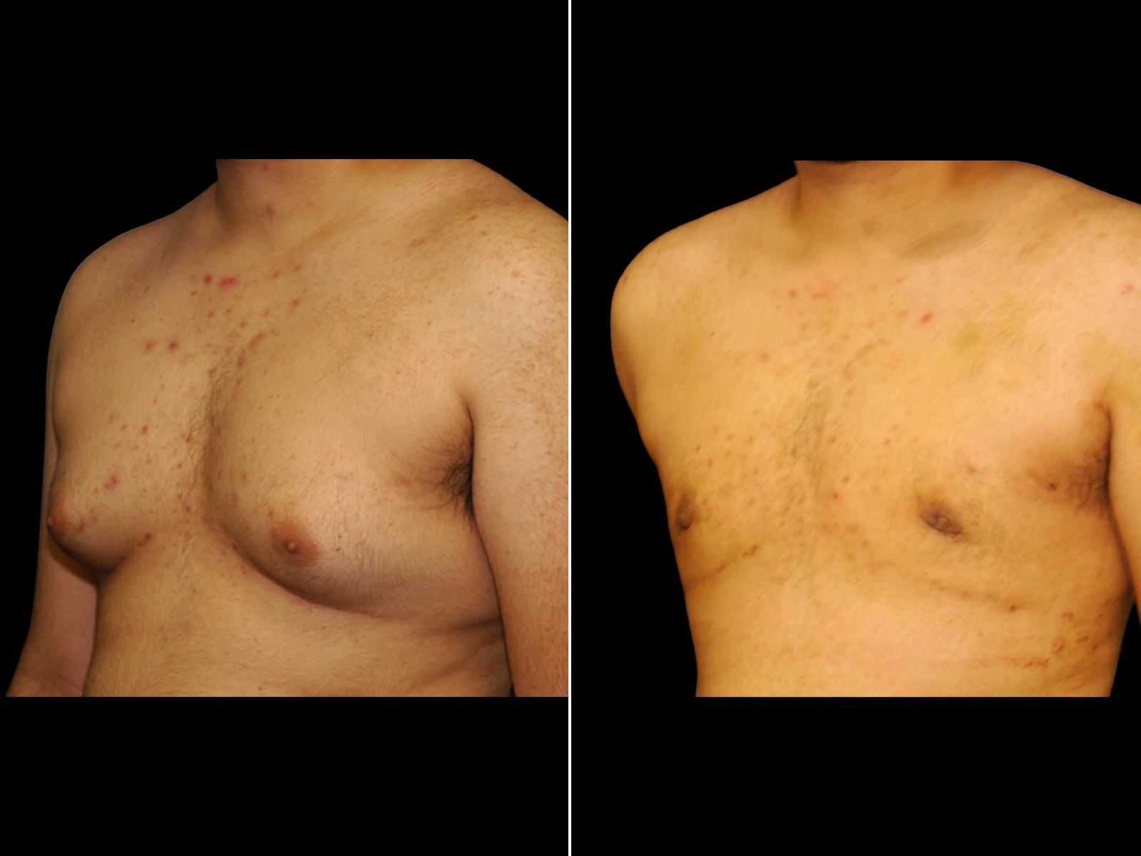 Gynecomastia C2
