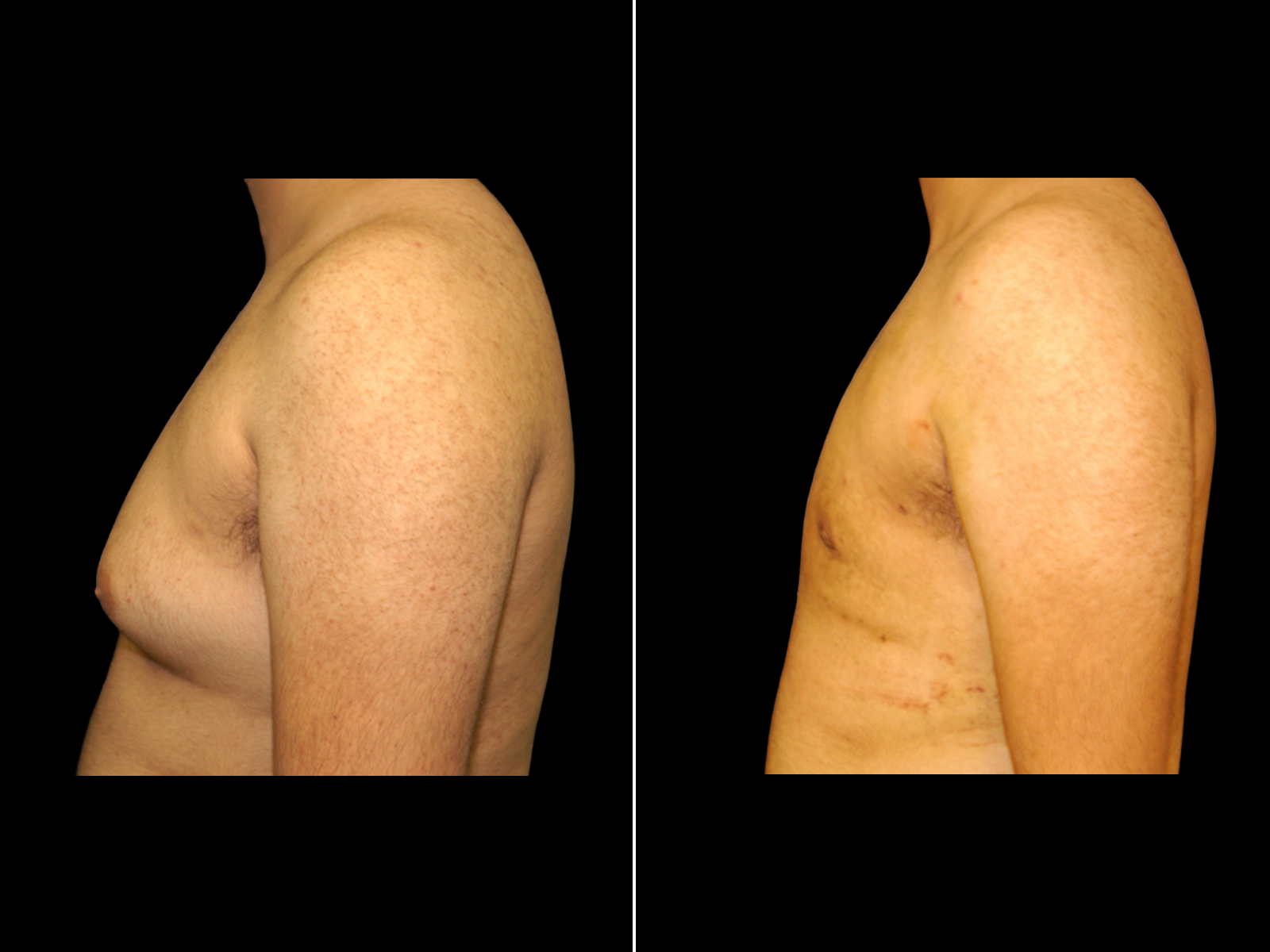 Gynecomastia C3