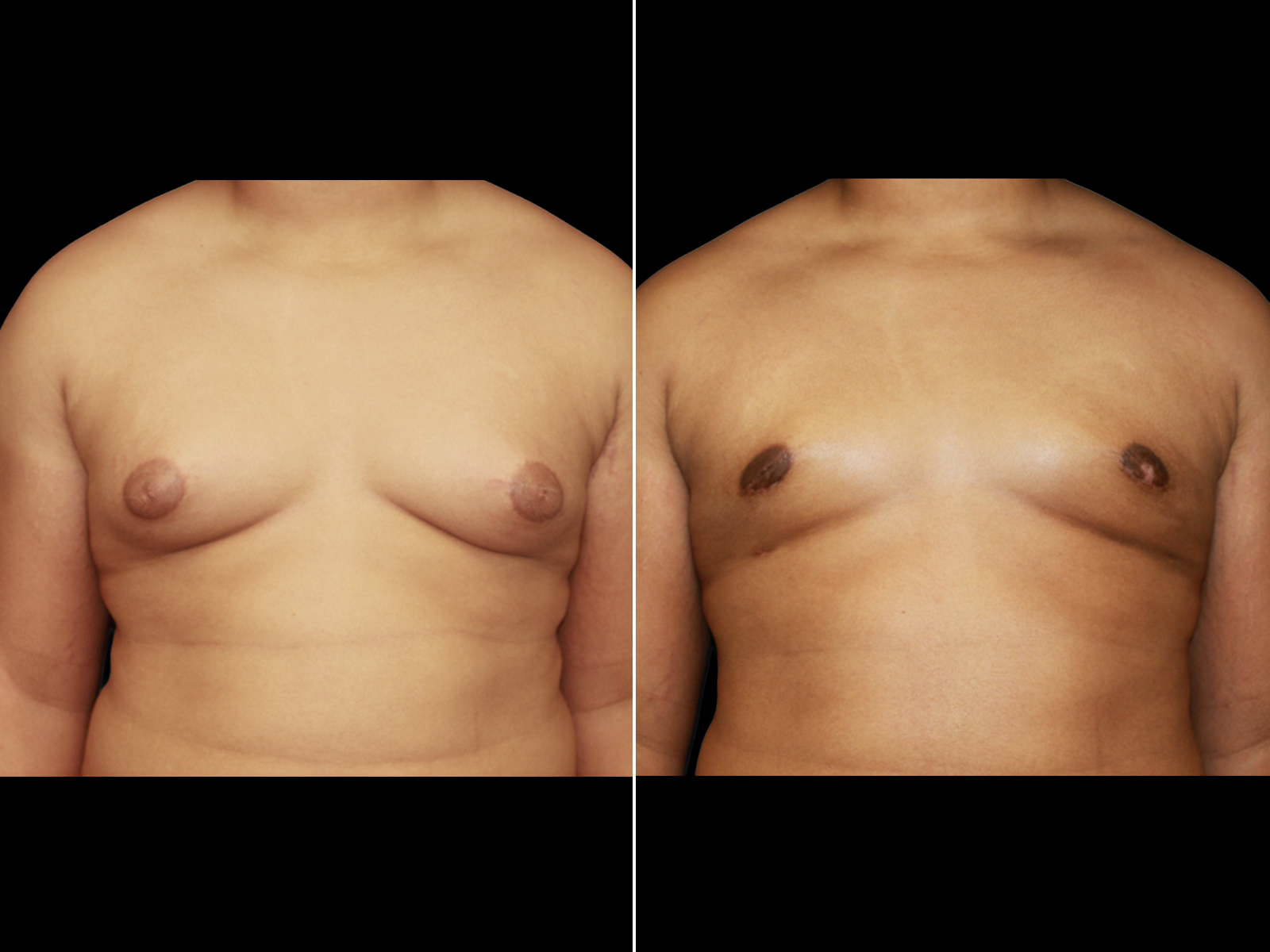 Gynecomastia D1